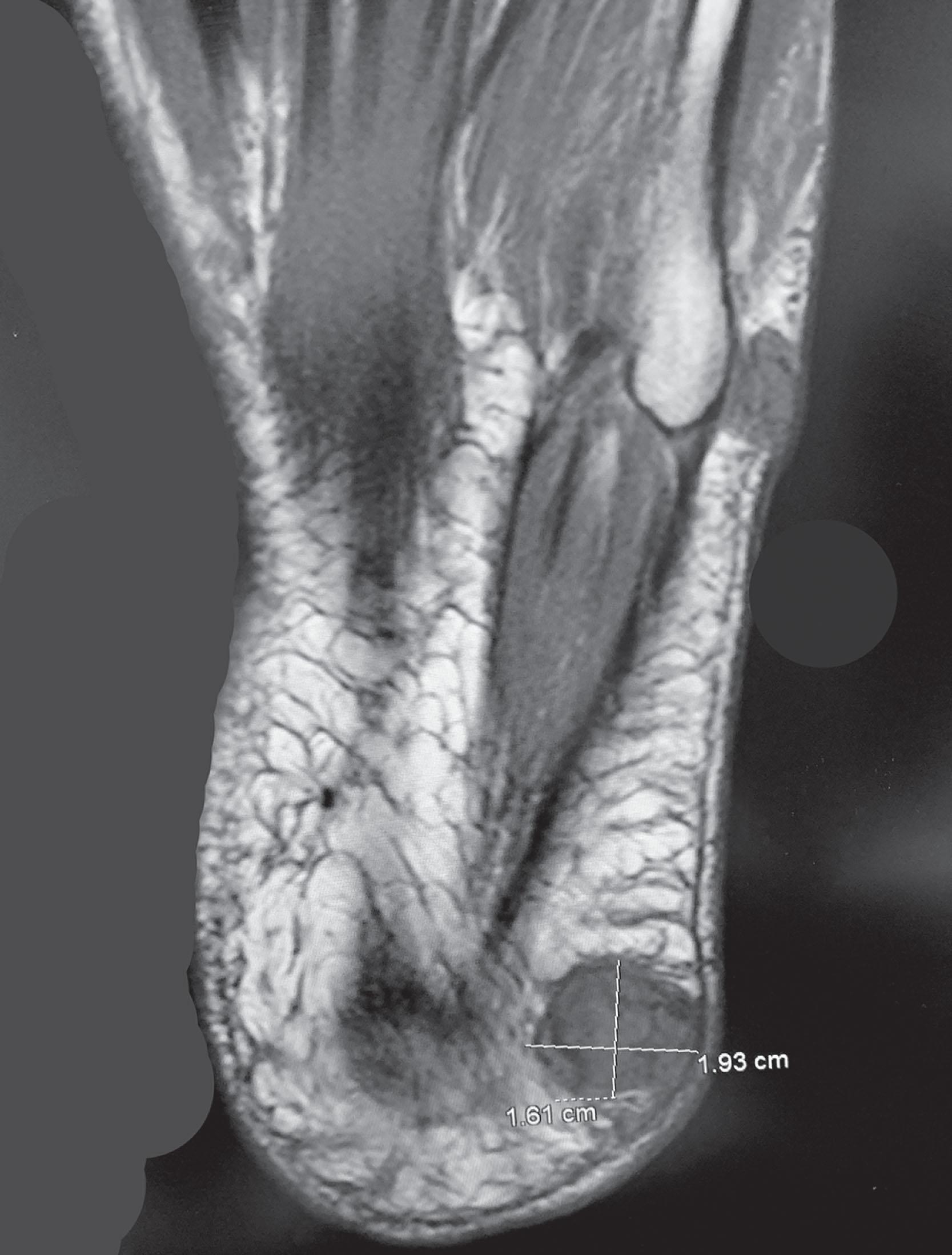 Fig. 21-34, MRI scan of plantar rheumatoid nodule.