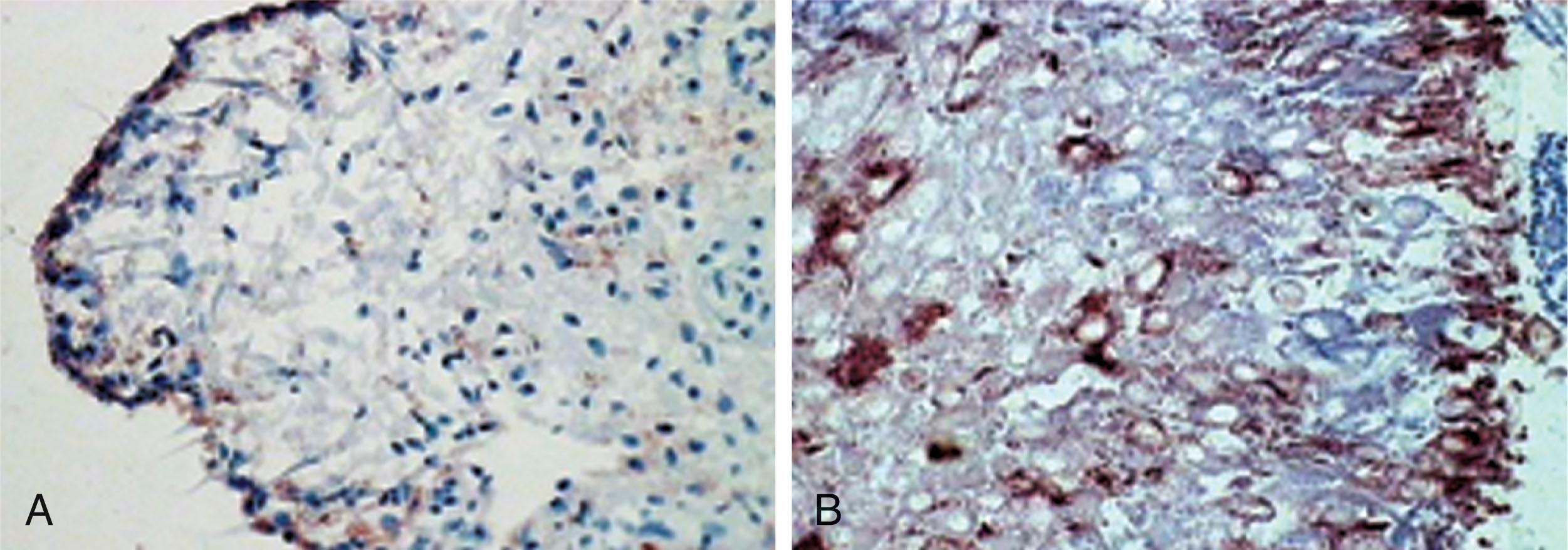 Fig. 21-35, A , Normal synovium and stained synovial macrophages. B , Rheumatoid synovium with a proliferation of macrophages stained red.