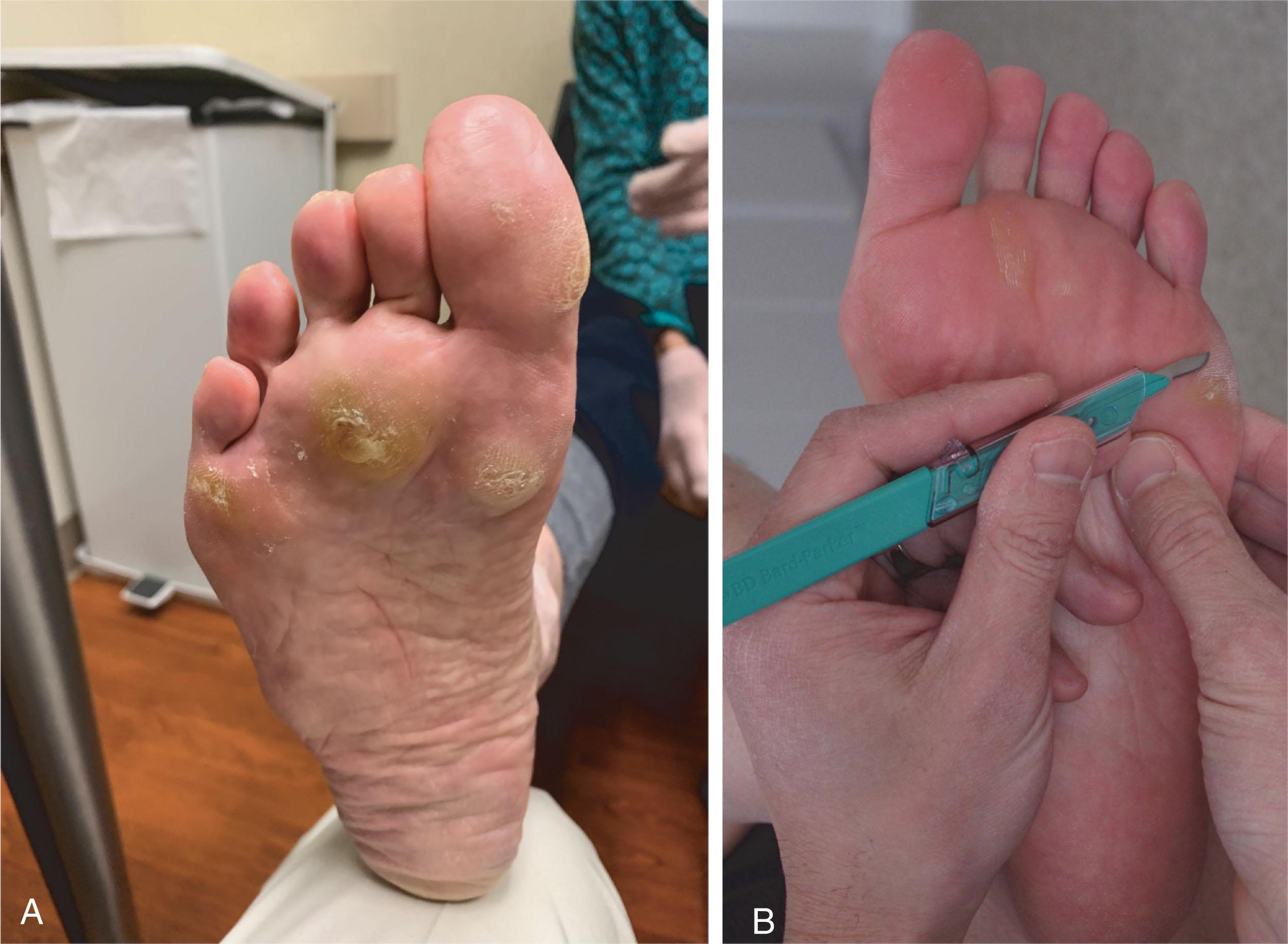 Fig. 21-37, A , Plantar forefoot callosities. B , In-office shaving of plantar callus.
