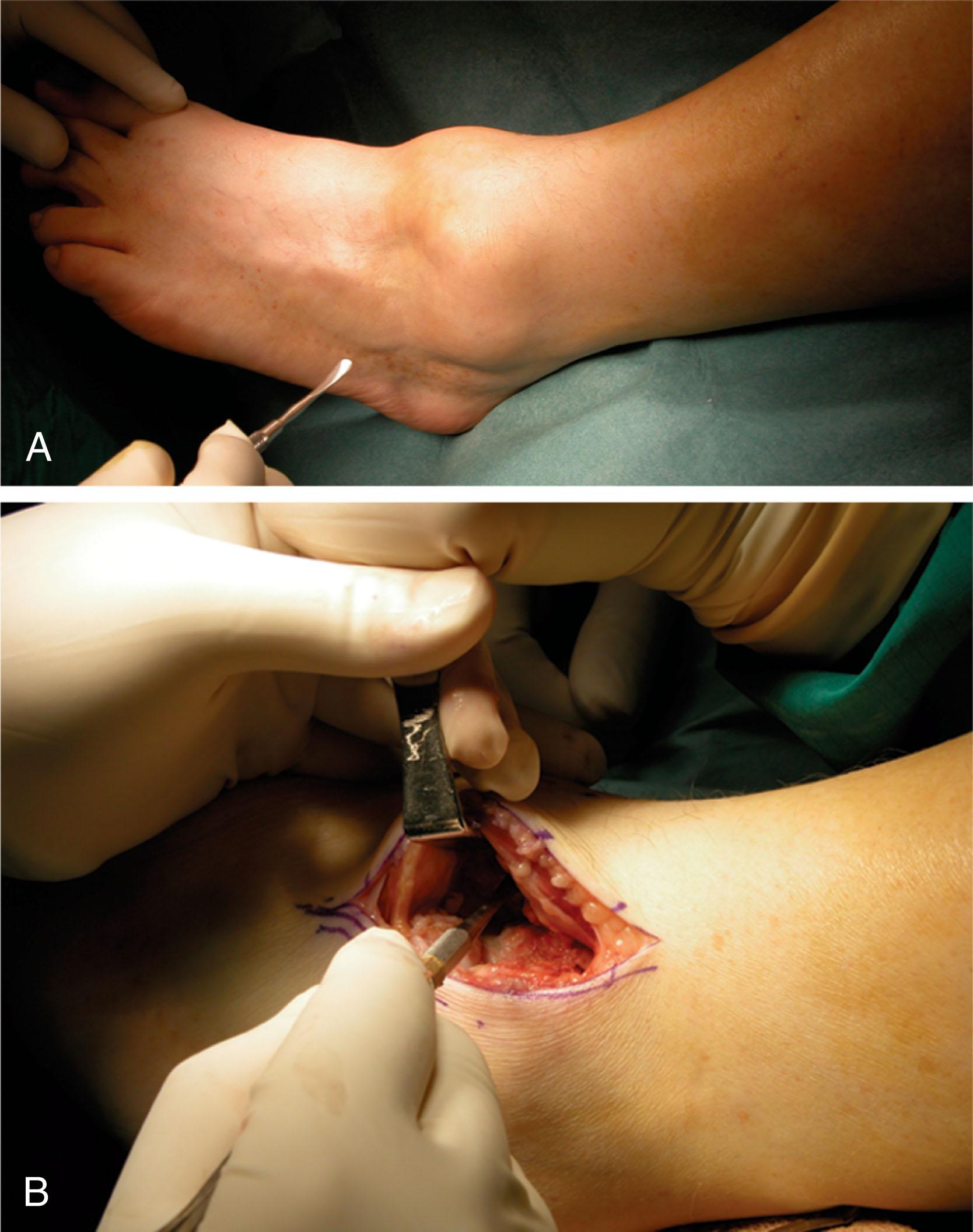 Fig. 21-40, Intraoperative photographs of ankle joint synovectomy. A , Preoperative. B , During ankle joint synovectomy.