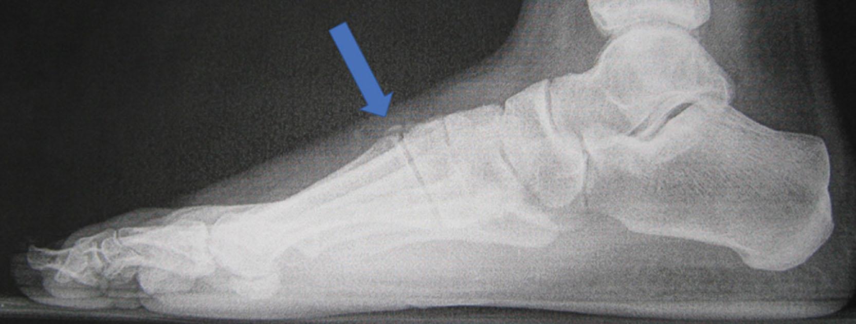 Fig. 21-4, Lateral radiograph demonstrating a dorsal first tarsometatarsal osteophyte ( arrow ).