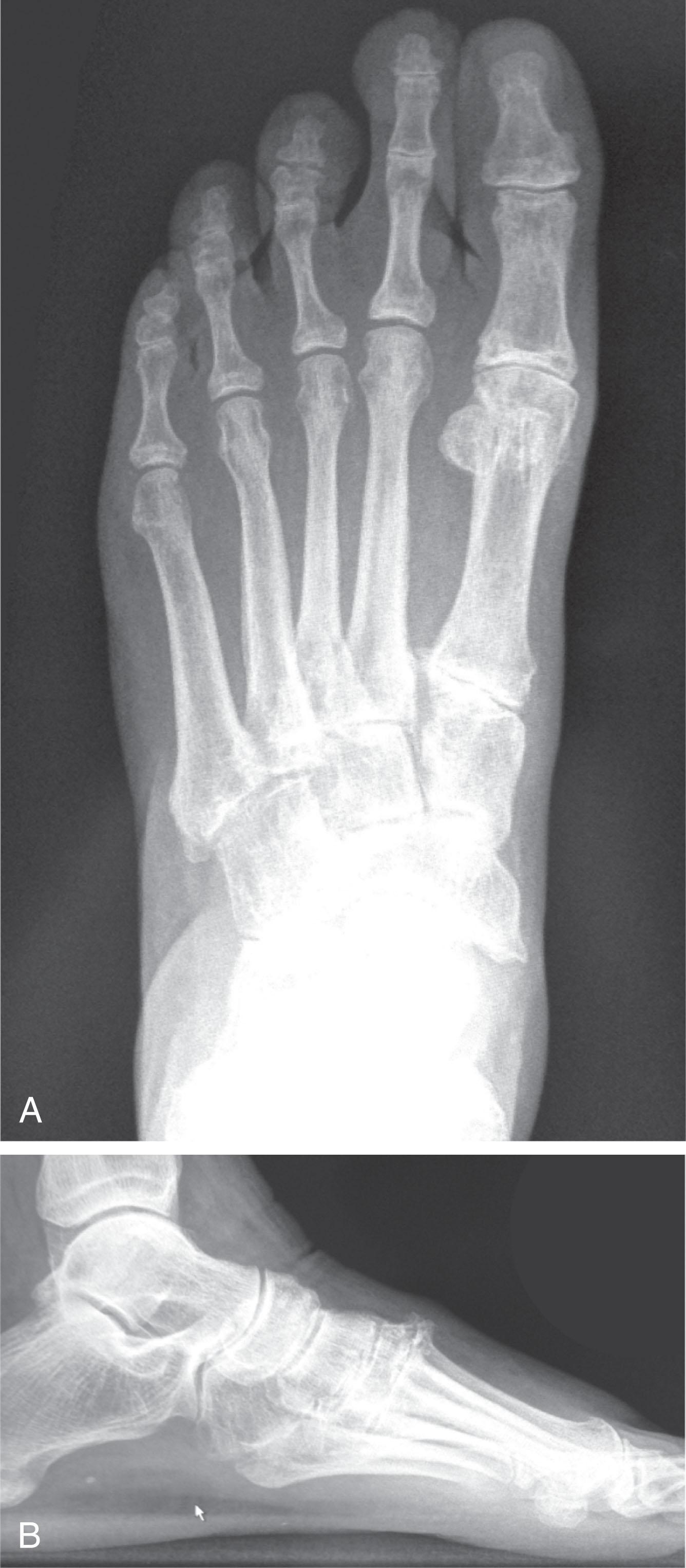 Fig. 21-5, A and B , Weight-bearing anteroposterior and lateral radiographs demonstrate degenerative arthritis of the tarsometatarsal joints.