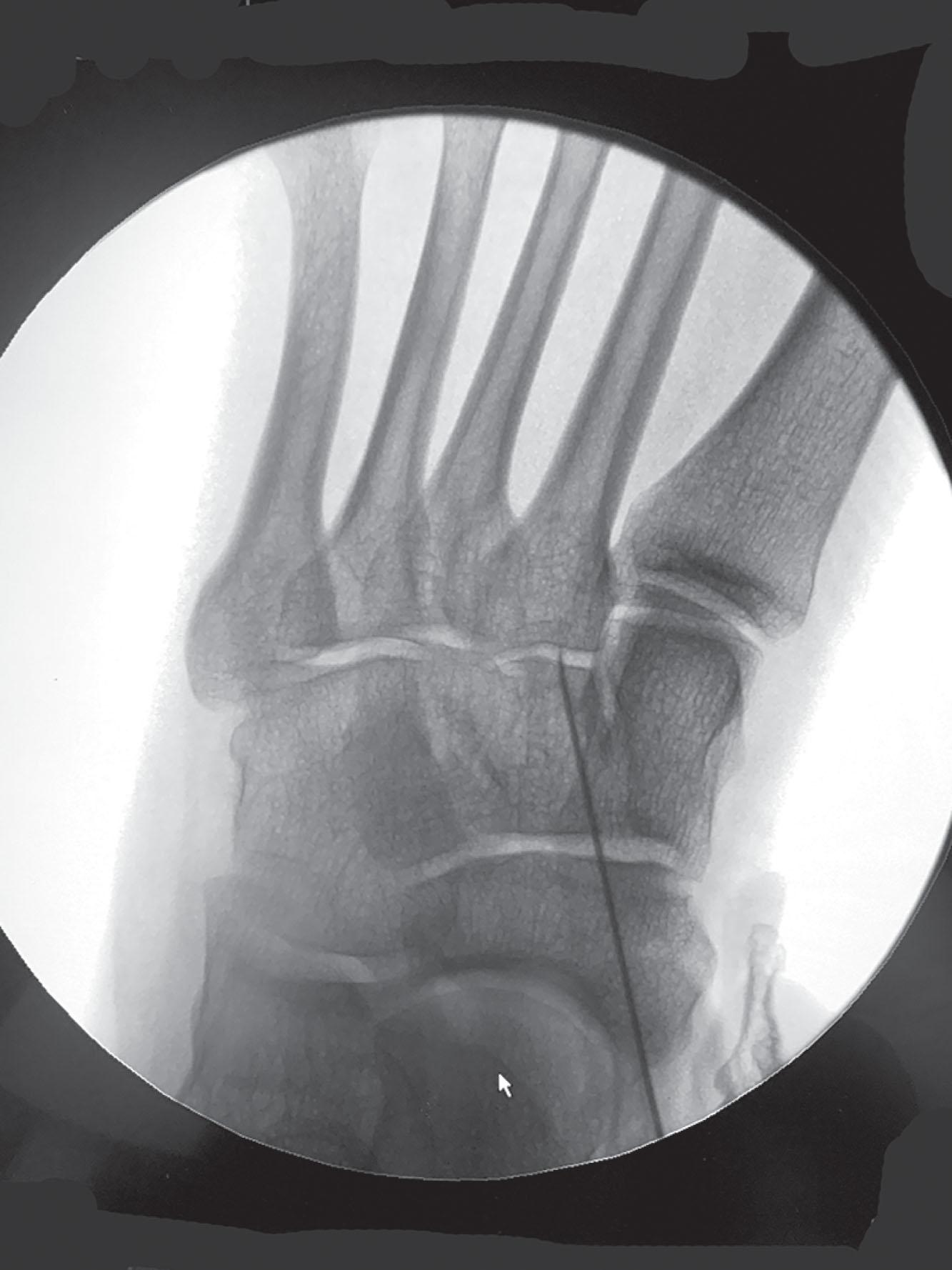 Fig. 21-6, Fluoroscopy showing intraarticular midfoot steroid injection.