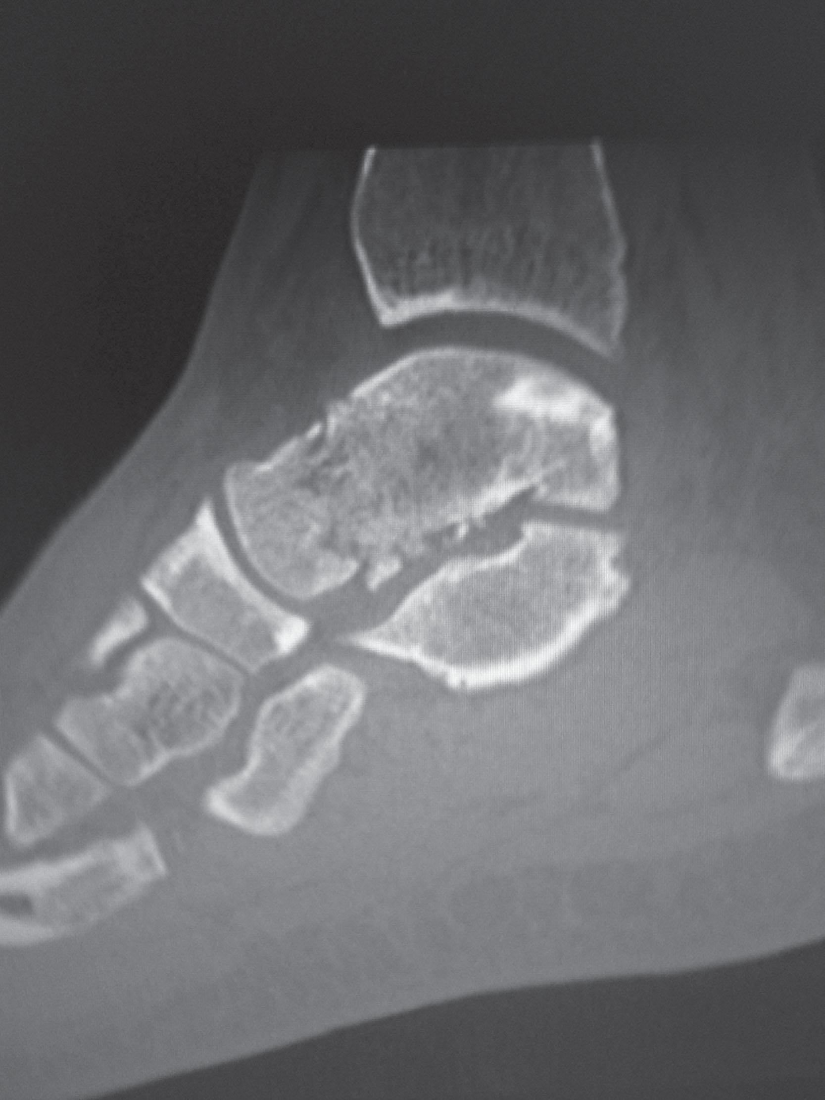 Fig. 21-7, Lateral computed tomography scan of a nondisplaced talar neck fracture.