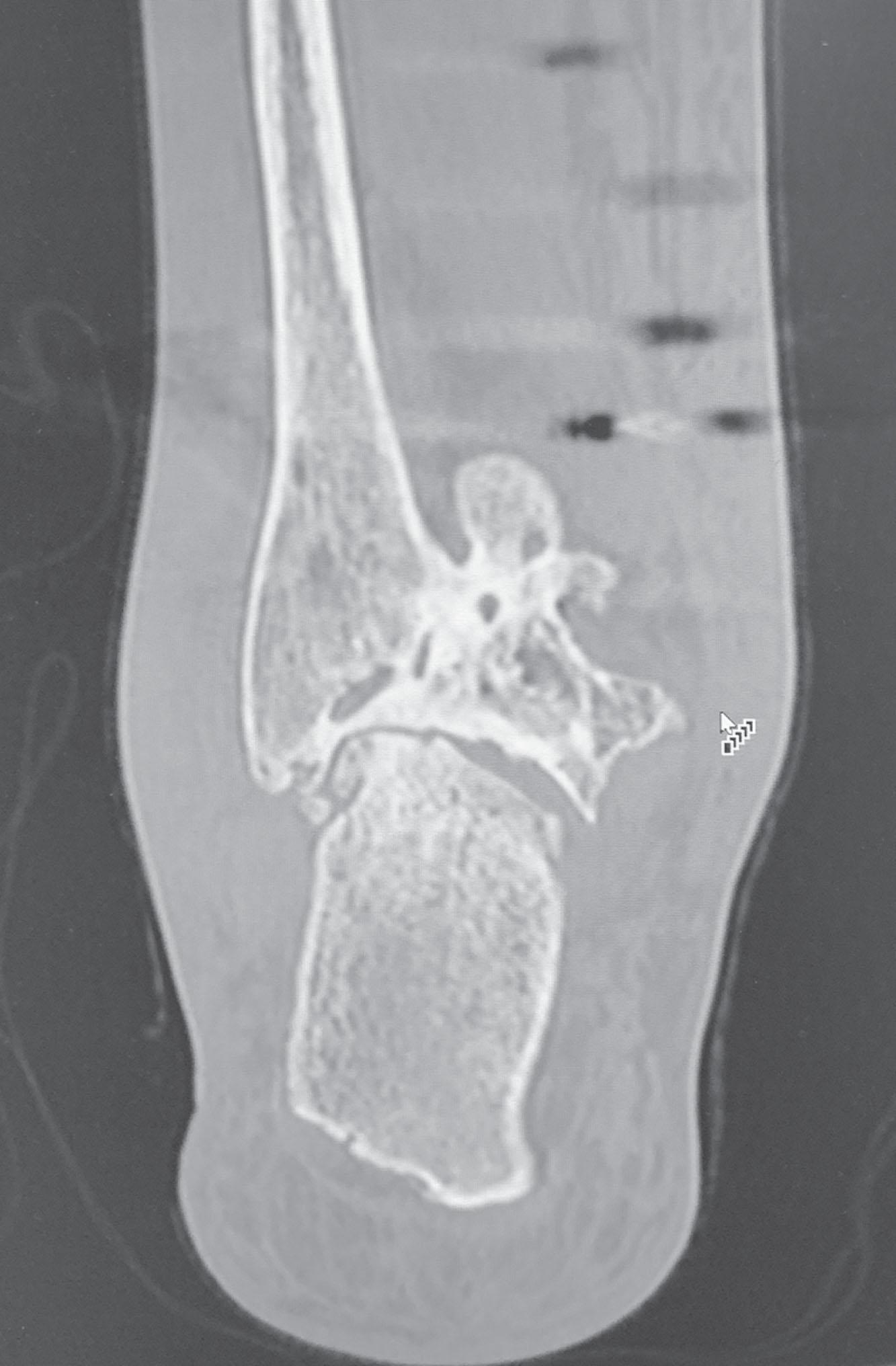 Fig. 21-8, Coronal computed tomography scan demonstrating posttraumatic subtalar arthritis.