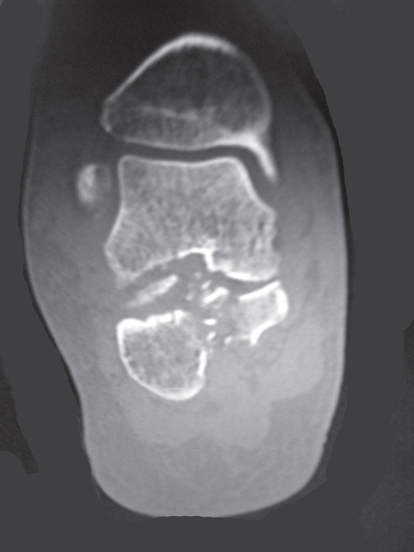 Fig. 21-9, Comminuted calcaneus fracture shown in a coronal computed tomography scan.