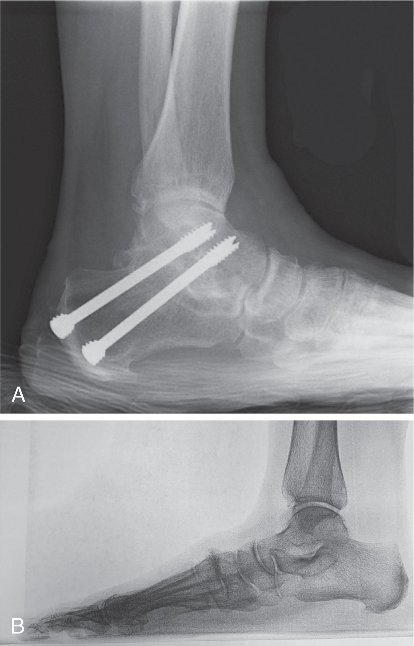 Fig. 21-10, Primary subtalar arthrodesis for subtalar arthritis with lag screw fixation.