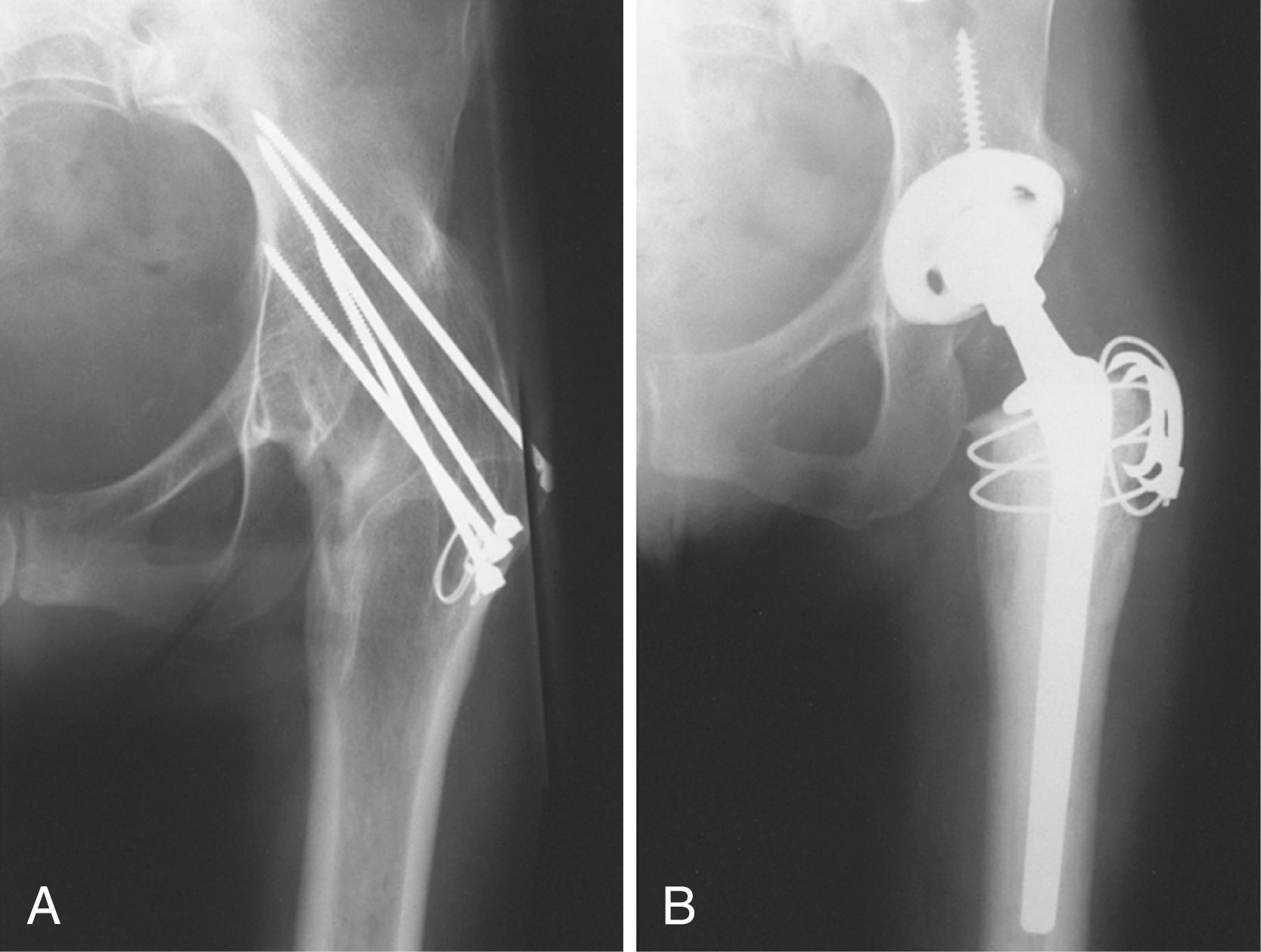 FIGURE 3.101, A, Arthrodesis in 61-year-old woman who developed disabling back pain four decades after successful arthrodesis of hip. B, After conversion to hybrid total hip arthroplasty. Trochanteric osteotomy provided excellent exposure. Patient had persistent Trendelenburg limp after surgery, but back pain had diminished.