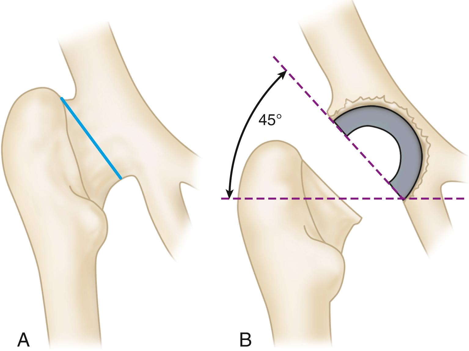 FIGURE 3.102, Osteotomy of neck in conversion of fusion to total hip arthroplasty. A, Neck usually is short and should be osteotomized proximally at base of trochanter. B, Sufficient bone is left on pelvic side for full coverage of cup at inclination of approximately 45 degrees and without penetrating medial cortex of pelvis.