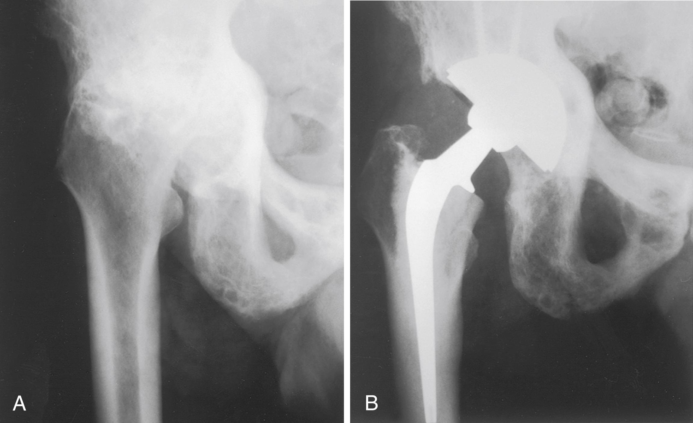 FIGURE 3.103, A, Extensive Paget disease of acetabulum and proximal femur in 82-year-old man. Note protrusio deformity and varus femoral neck. B, After total hip replacement. Acetabulum required autogenous bone graft from femoral head. Considerable blood loss occurred during acetabular preparation. Cementless acetabular component appears bone ingrown 5 years after surgery.