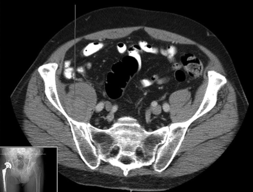 FIGURE 3.104, CT scan shows fluid within the iliopsoas muscle sheath consistent with hematoma secondary to impingement from acetabular component.