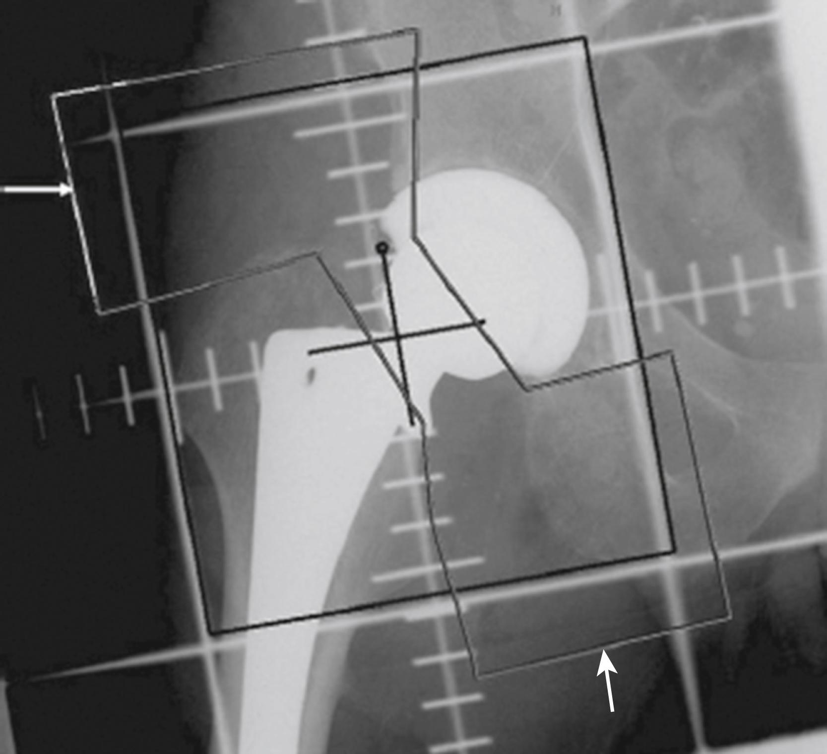 FIGURE 3.105, Anteroposterior radiograph showing radiation portals for total hip arthroplasty. Potential ingrowth portions of femoral and acetabular components were spared.