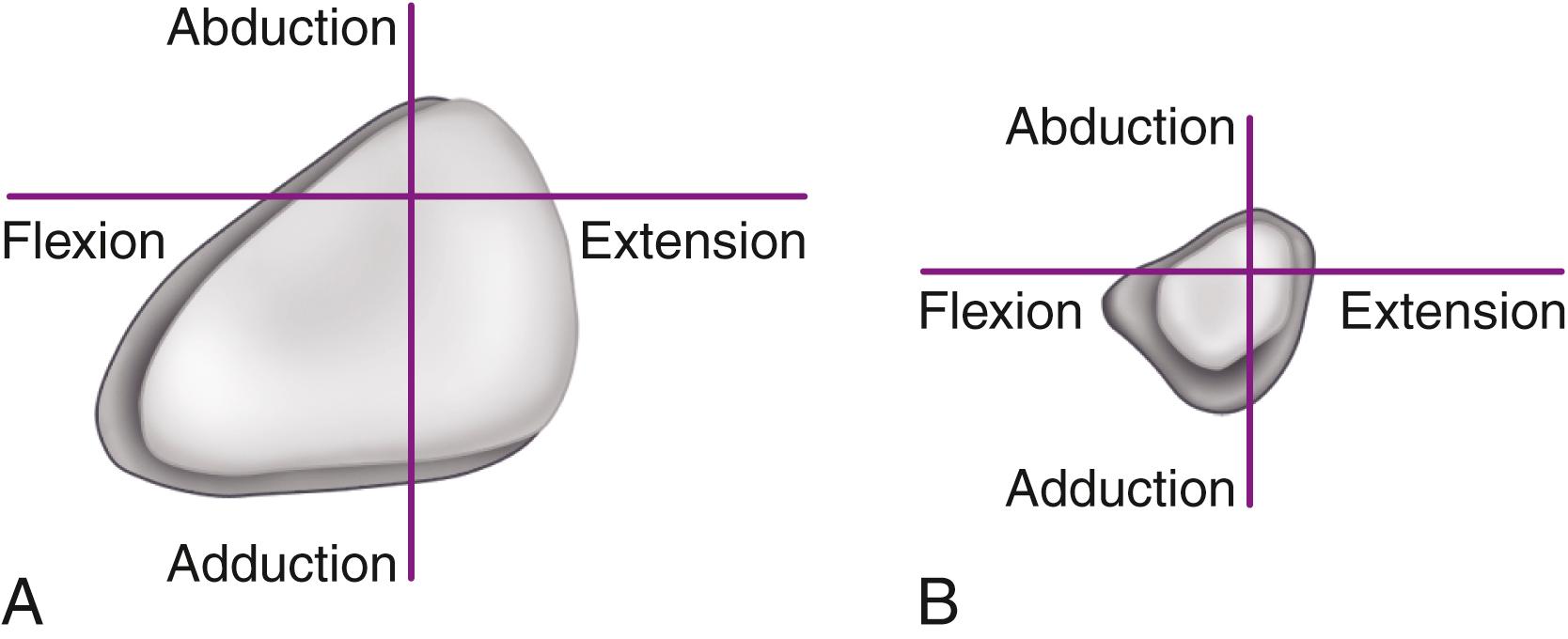 FIGURE 3.13, Effects of head size and neck geometry on range of motion. A, Changing from 28-mm head (light shading) to 32-mm head (dark shading) results in 8-degree increase in flexion before impingement. B, Large circular taper has dramatically decreased range of motion to impingement (dark shading), which is diminished even further by having skirted modular head (light shading) .