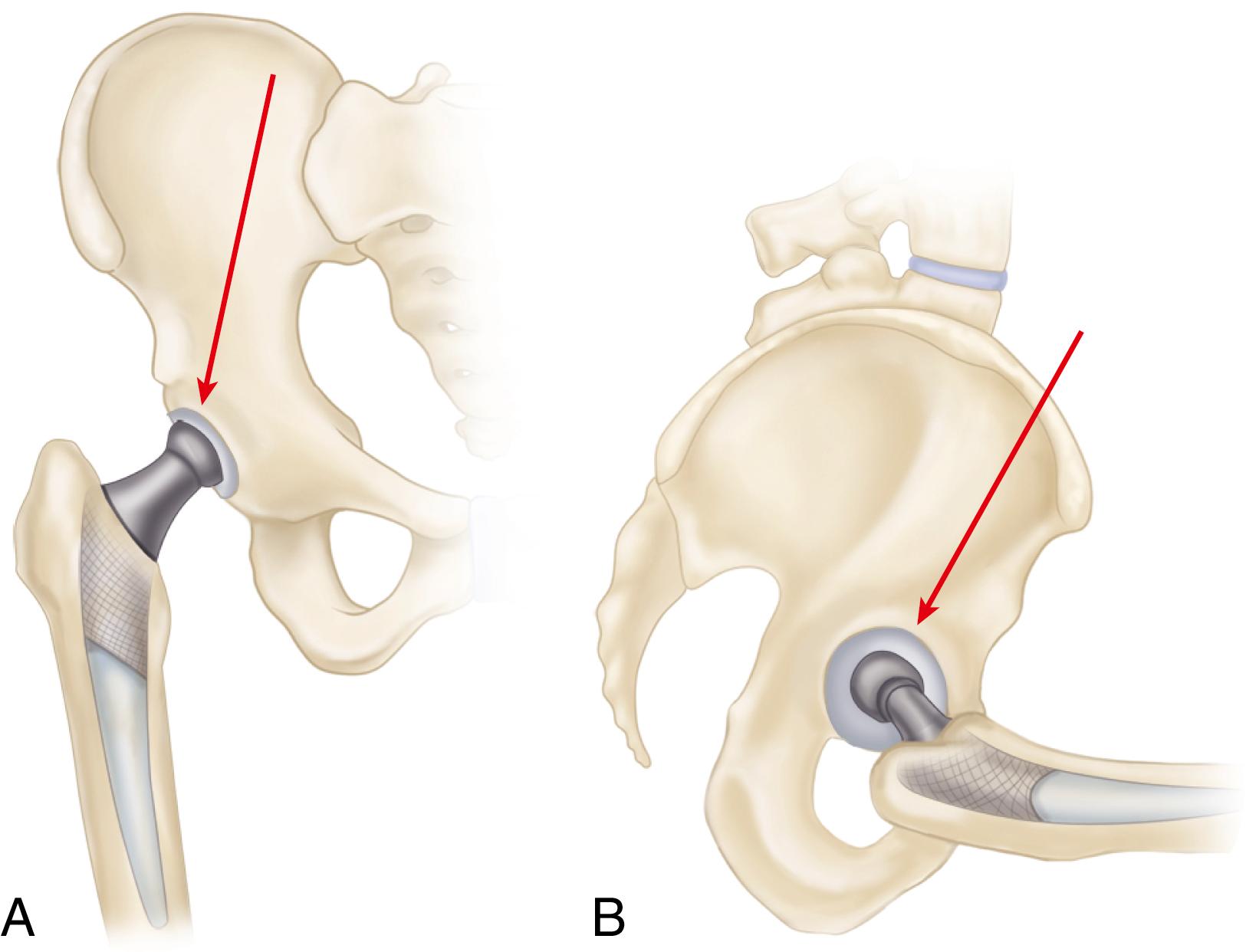 FIGURE 3.2, Forces producing torsion of stem. Forces acting on hip in coronal plane (A) tend to deflect stem medially, and forces acting in sagittal plane (B) , especially with hip flexed or when lifting, tend to deflect stem posteriorly. Combined, they produce torsion of stem.