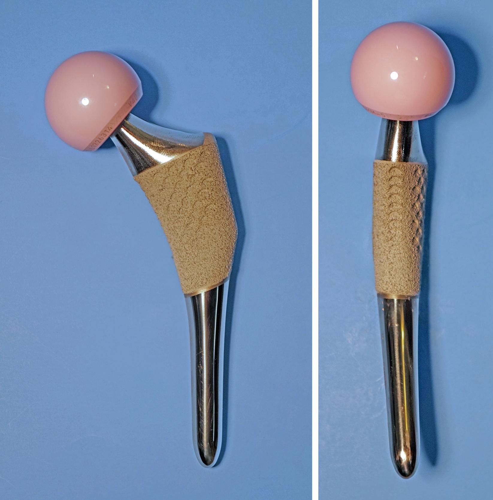 FIGURE 3.27, Anato anatomic stem. Asymmetric metaphyseal shape conforms more closely to proximal femoral geometry. Femoral neck is anteverted 7 degrees, and dedicated right and left stems are required.