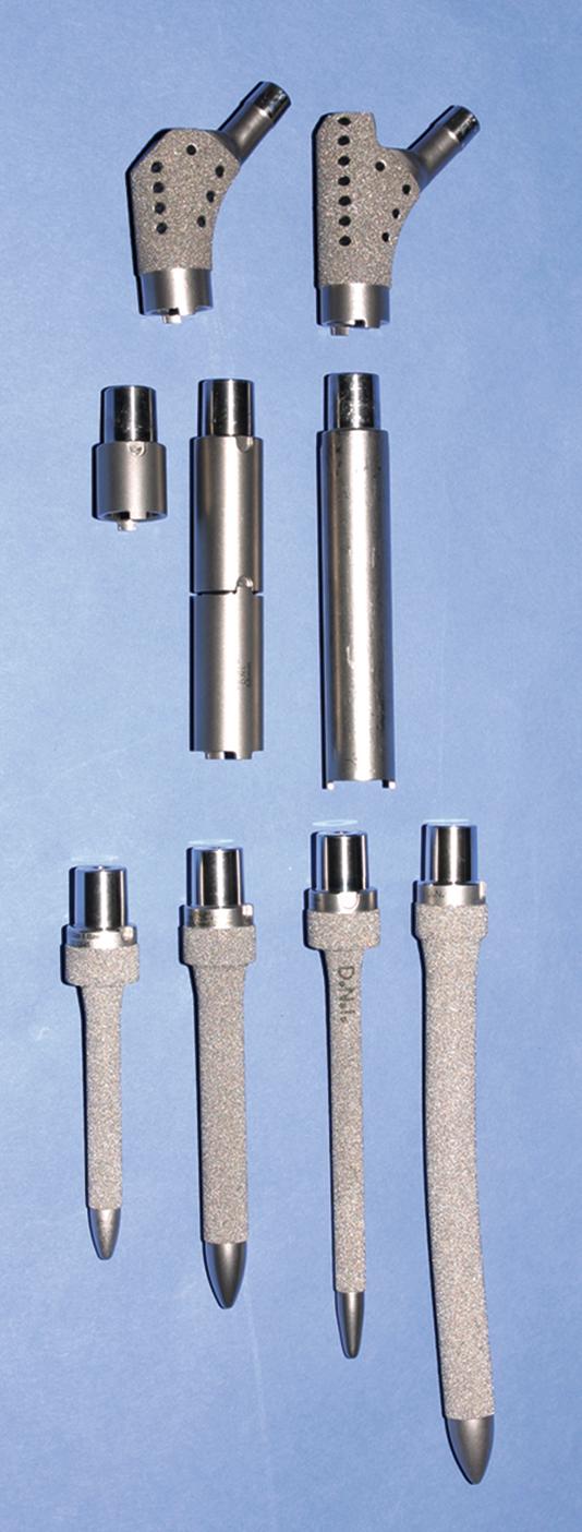 FIGURE 3.29, Specialized femoral components for replacement of variable length of proximal femur. Orthogenesis limb preservation system uses modular segmental replacement stem for replacement of large segment of proximal femur. Stem can be combined with total knee replacement to replace entire femur.