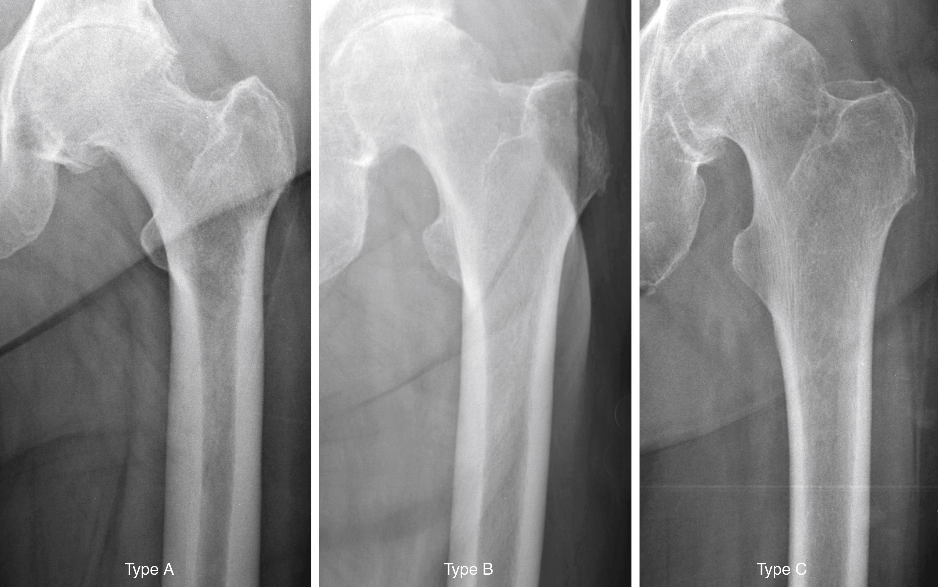 FIGURE 3.3, Dorr radiographic categorization of proximal femurs according to shape, correlation with cortical thickness, and canal dimension.