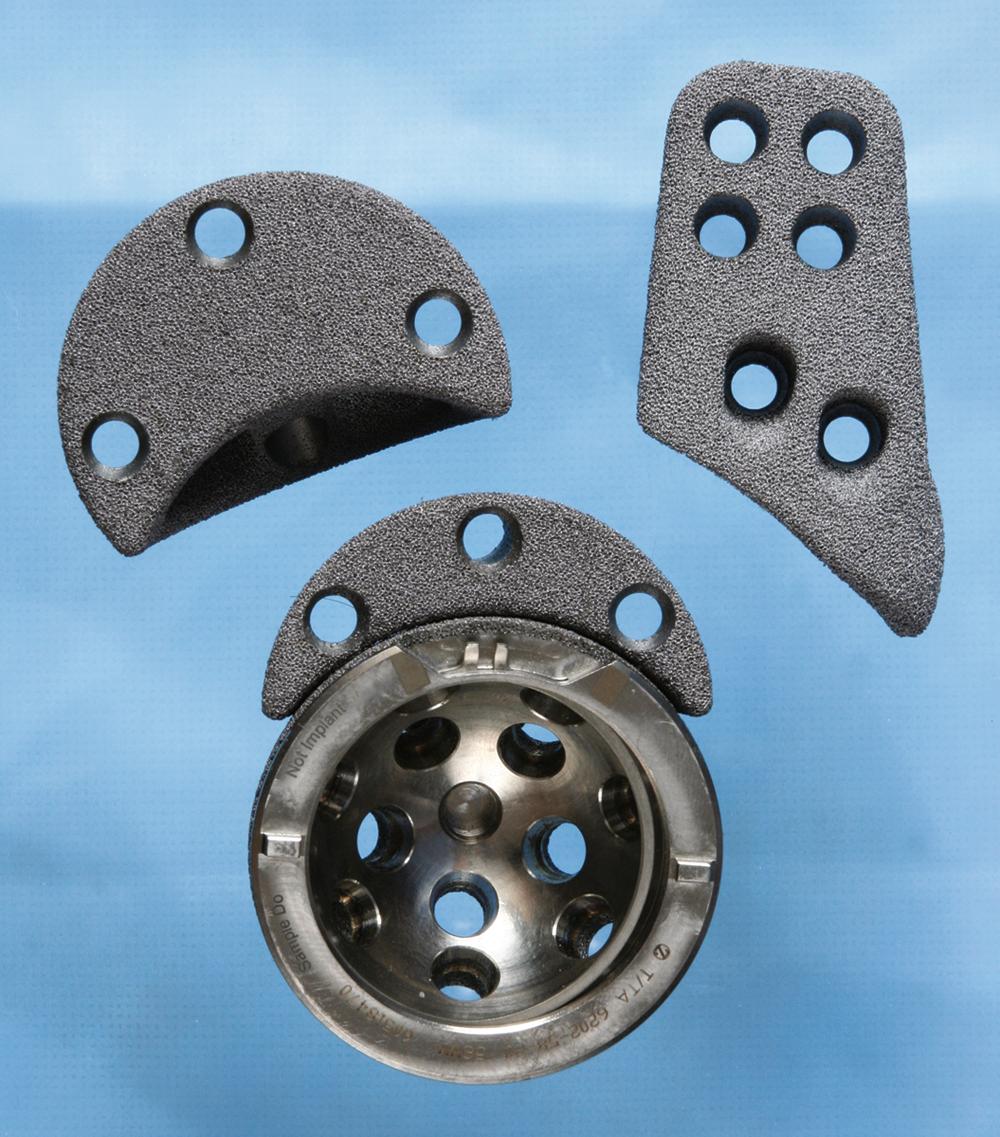 FIGURE 3.31, Zimmer trabecular metal acetabular component with various modular augments for bony deficiencies.