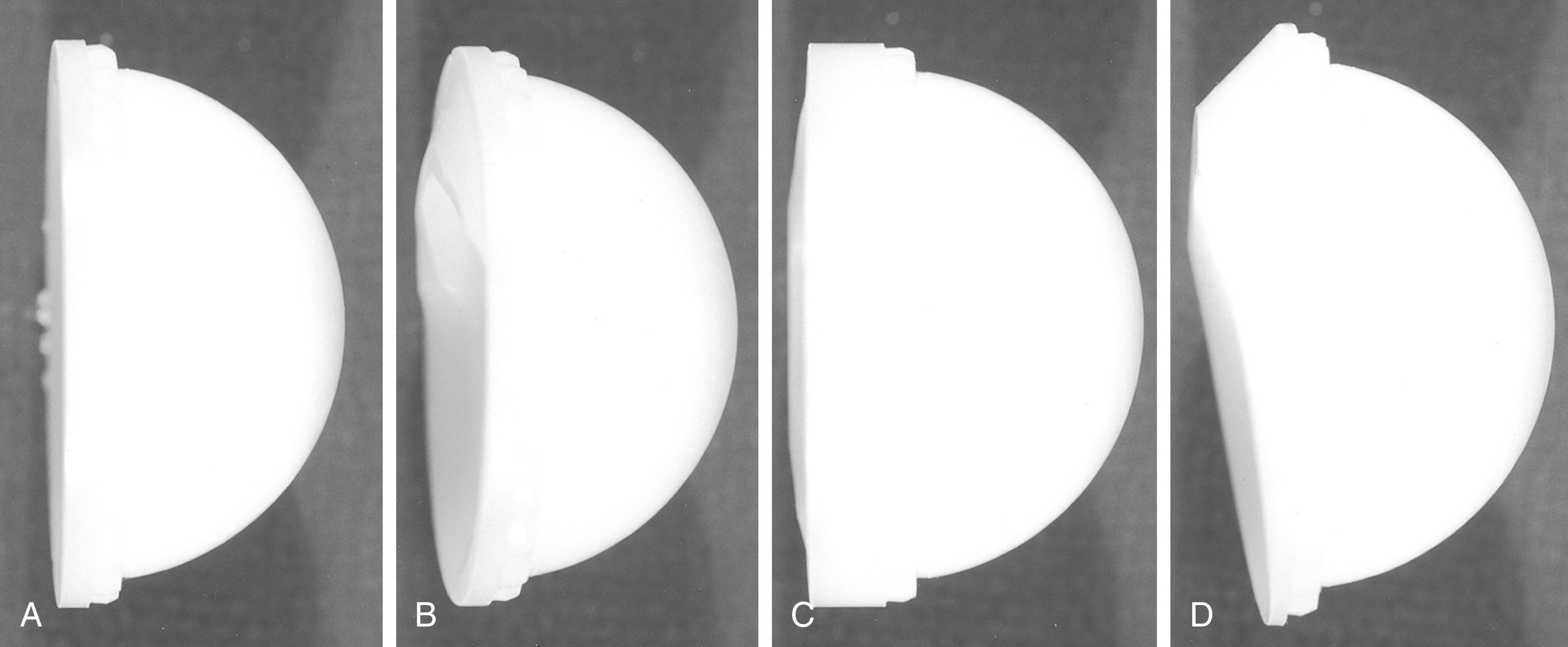 FIGURE 3.33, Array of liner options available with contemporary modular acetabular system: standard flat liner (A) , posterior lip without anteversion (B) , 4-mm lateralized flat (C) , and anteverted 20 degrees (D) . (Courtesy Smith & Nephew, Memphis, TN.) SEE TECHNIQUE 3.3.