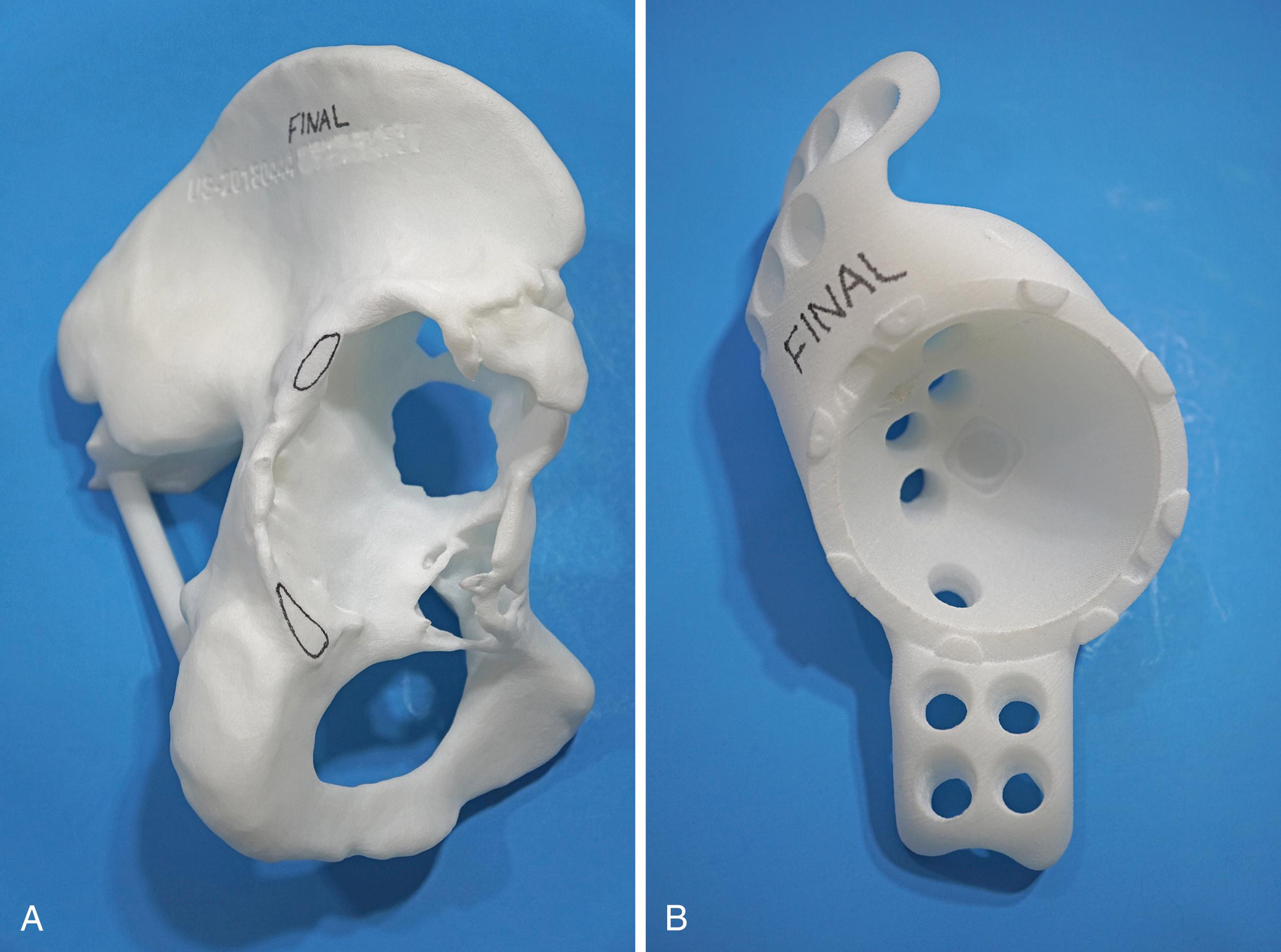 FIGURE 3.36, Custom triflange acetabular model. A, CT-based model showing large acetabular deficiencies. B, Custom acetabular component has intimate fit and flanges for multiple screw fixation.