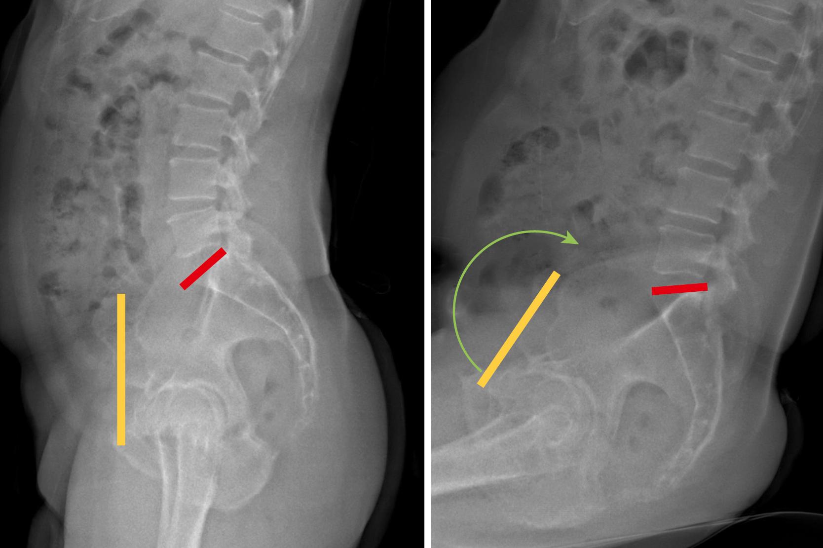 FIGURE 3.40, Standing and sitting lateral radiographs of a patient with normal spinal pelvic mobility. When the patient sits, lumbar lordosis decreases and the pelvis “rolls back,” which is demonstrated by an increase in posterior pelvic tilt (yellow line) and a flattening of the sacral slope (red line) .
