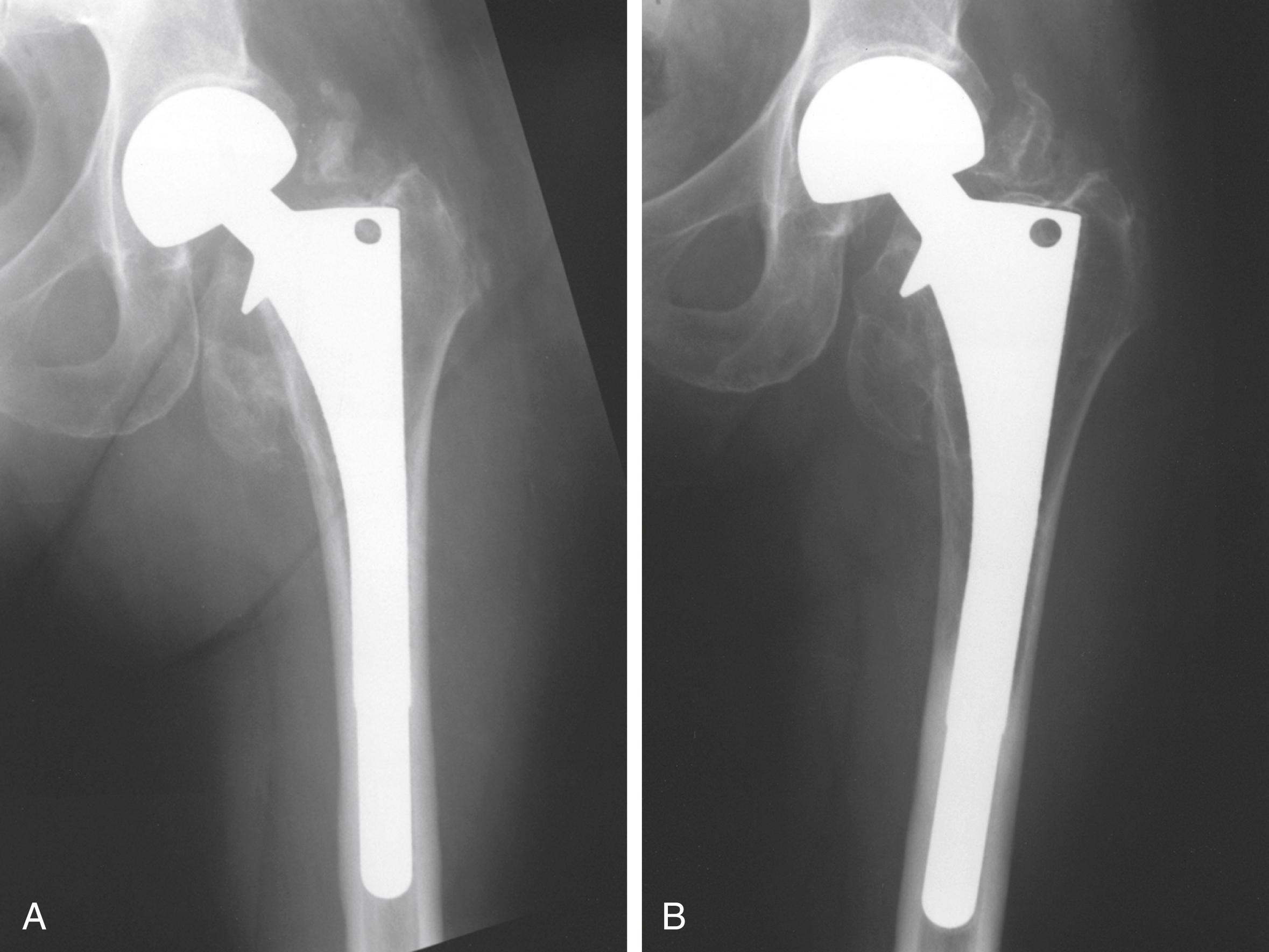 FIGURE 3.4, Response of bone to load. A, Postoperative radiograph of extensively porous-coated stem. B, Two years later, cortical and cancellous bone density in proximal femur has decreased as a result of stress shielding.