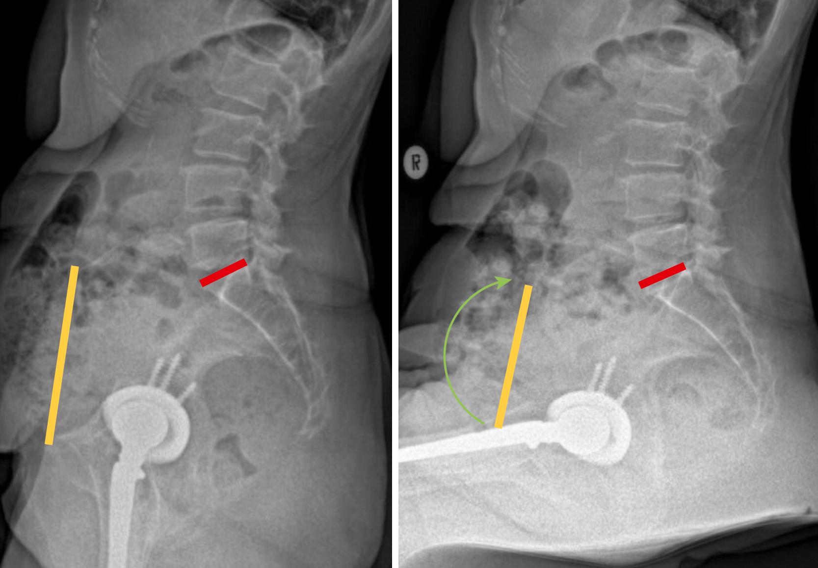 FIGURE 3.41, Standing and sitting lateral radiographs of a patient with a stiff spine who underwent revision of the shown construct for asymmetric polyethylene wear, osteolysis, and posterior instability. Note the lack of “pelvic rollback” in the seated position (no change in sacral slope, red ) and the proximity of the flexing proximal femur to the anterior acetabular rim (yellow) .