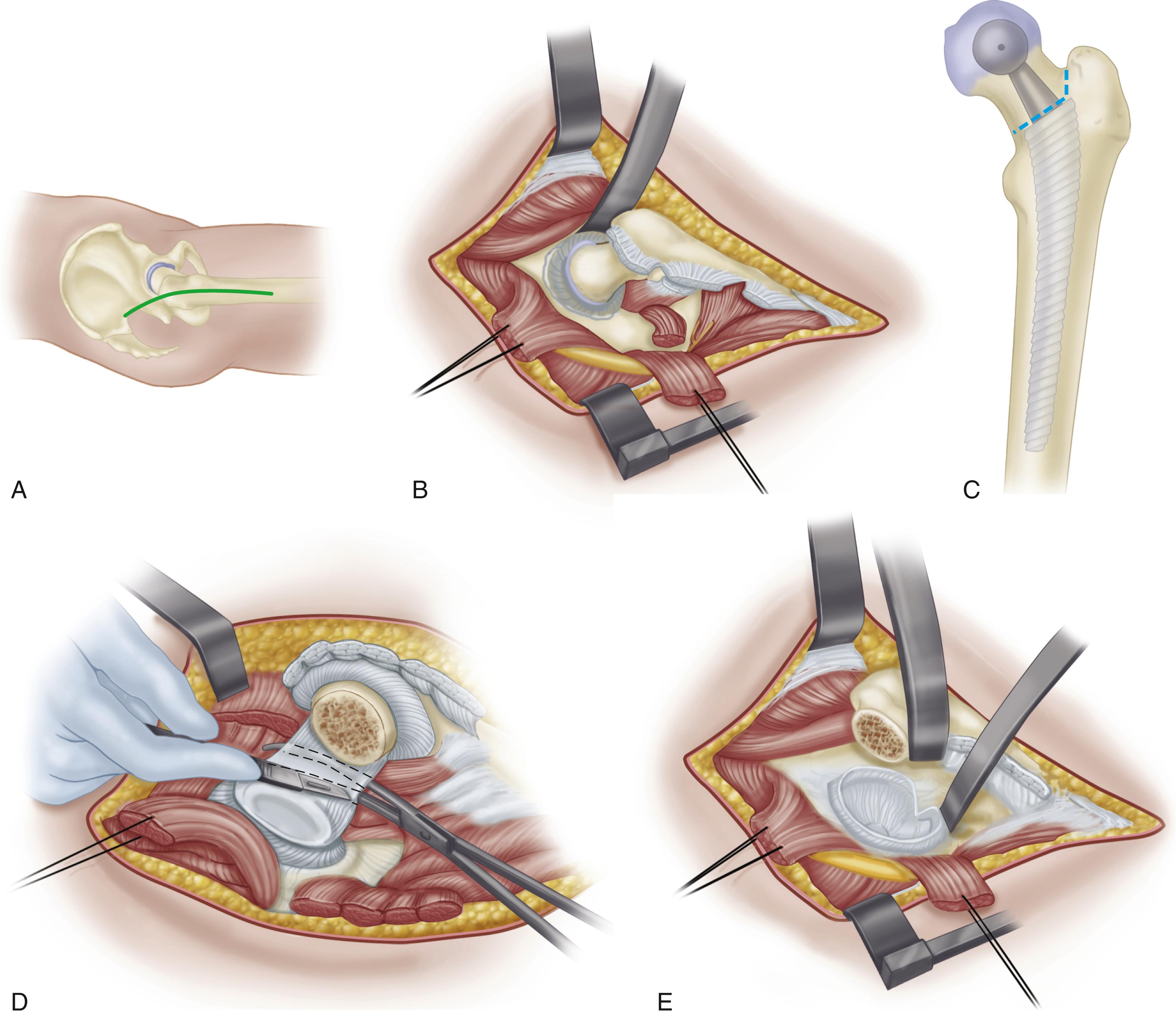 FIGURE 3.43, A, Skin incision for posterolateral approach to hip. B, Completed posterior soft-tissue dissection. C, Neck cut planned at appropriate level and angle by using trial components of templated size. D, Anterior capsule divided along course of psoas tendon sheath. E, Femur retracted well anteriorly to allow unimpeded access to acetabulum. ( A, B, and E redrawn from Capello WN: Uncemented hip replacement, Tech Orthop 1:11, 1986; also Courtesy Indiana University School of Medicine.) SEE TECHNIQUES 3.2 AND 3.4.