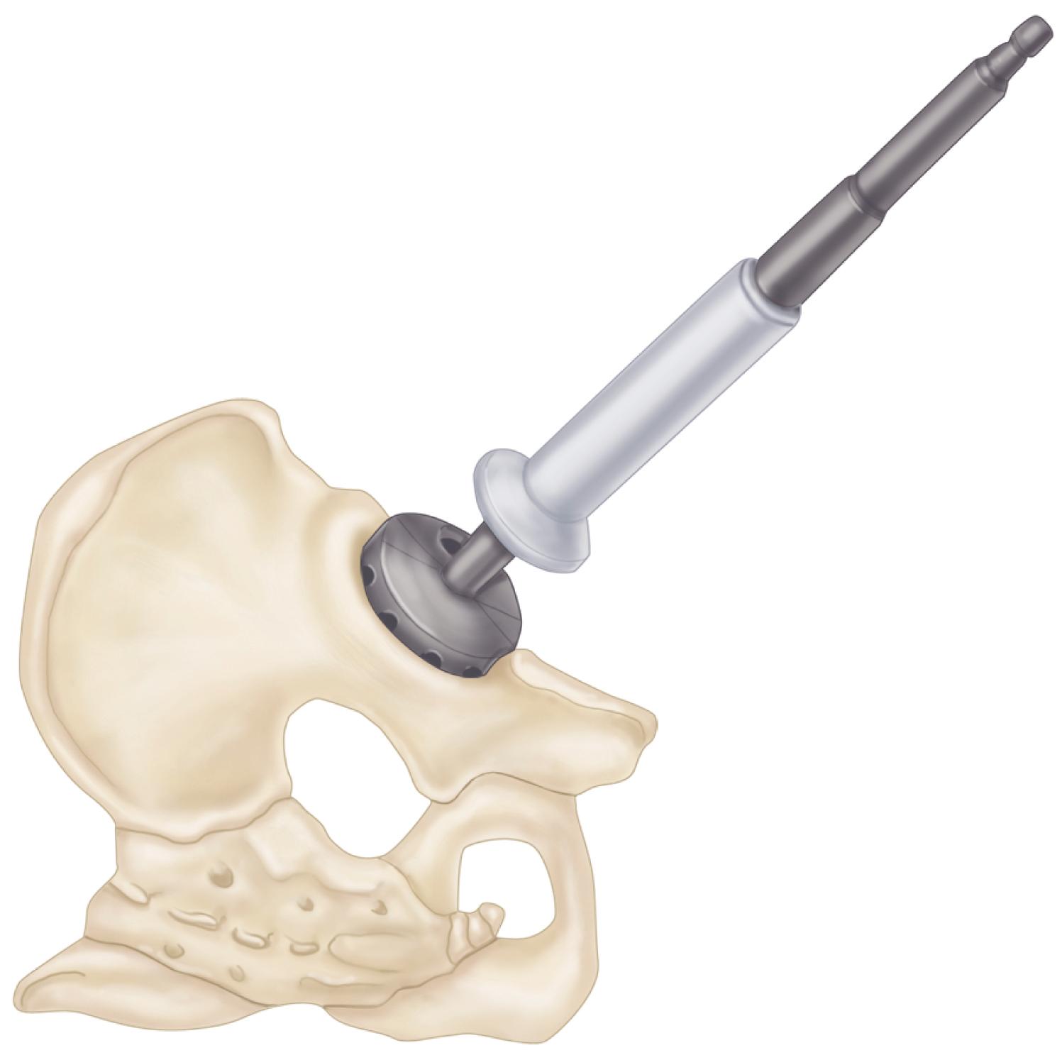 FIGURE 3.45, Reaming of acetabulum. SEE TECHNIQUES 3.2 AND 3.7.