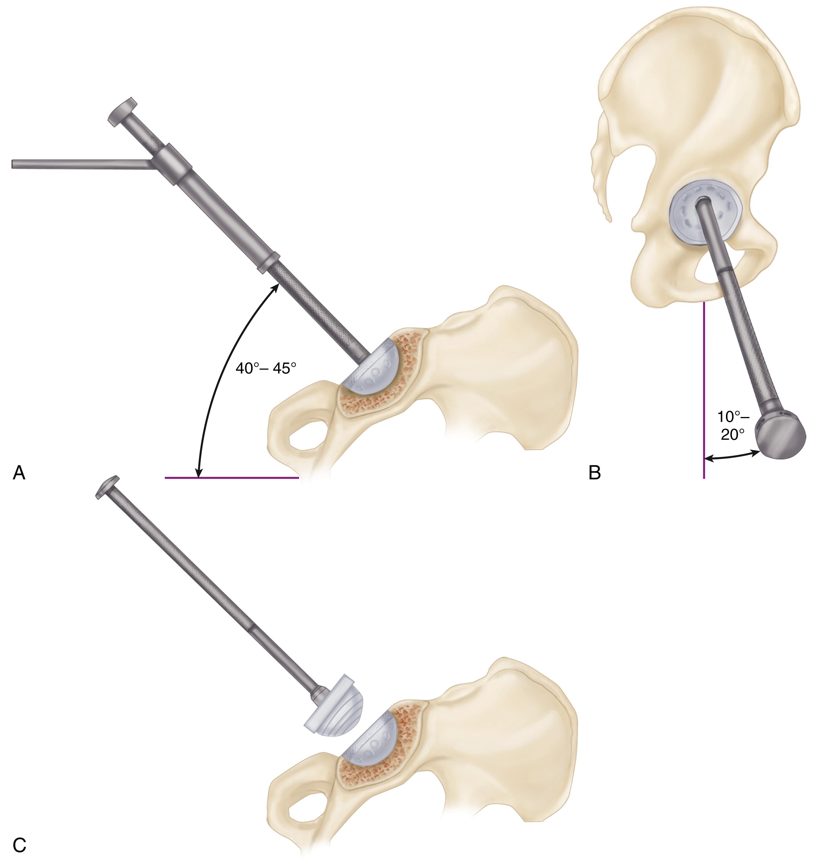 FIGURE 3.47, A, Socket positioning in abduction. B, Anteversion. C, Insertion of liner. SEE TECHNIQUE 3.3.