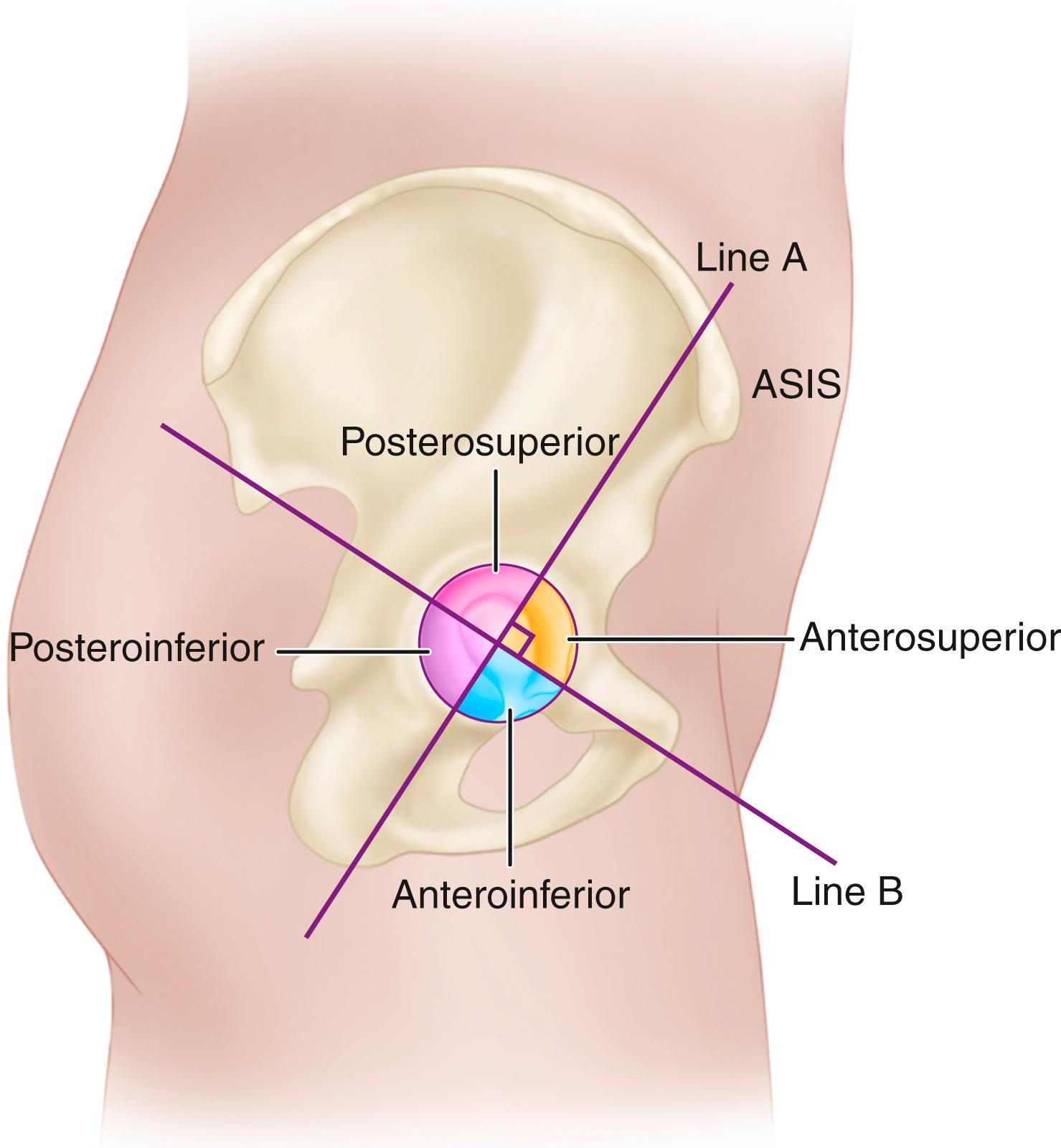 FIGURE 3.46, Acetabular quadrant system described by Wasielewski et al. for determining safe screw placement (see text). Quadrants are formed by intersections of lines A and B. Line A extends from anterior superior iliac spine (ASIS) through center of acetabulum to posterior aspect of fovea, dividing acetabulum in half. Line B is drawn perpendicular to line A at midpoint of acetabulum, dividing it into quadrants: anterosuperior, anteroinferior, posterosuperior, and posteroinferior.