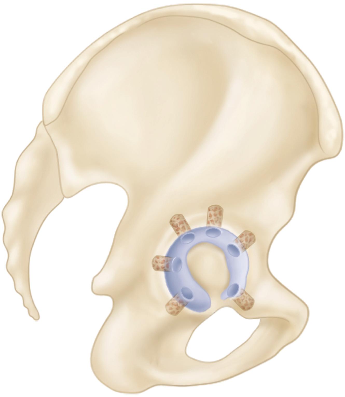FIGURE 3.48, Fixation holes for cement in acetabulum. SEE TECHNIQUE 3.4.