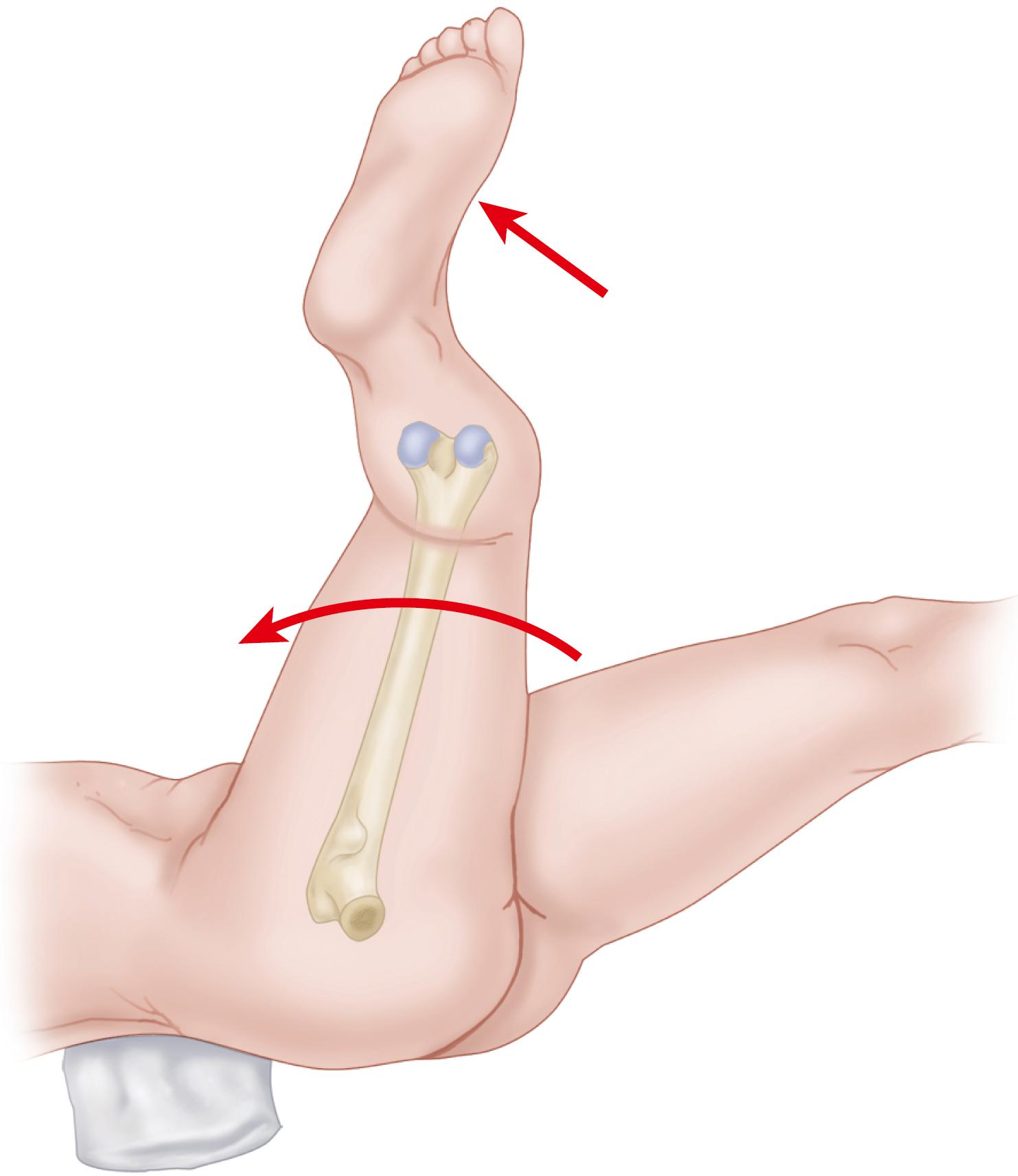 FIGURE 3.50, Positioning of femur for reaming, with patient in lateral position (looking down on patient). Hip is internally rotated, flexed, and adducted until tibia is vertical and axis of knee joint is horizontal. Femoral neck now points downward 15 to 20 degrees, and consequently table is tilted to opposite side for reaming of canal. (From Eftekhar NS: Principles of total hip arthroplasty , St. Louis, 1978, Mosby.) SEE TECHNIQUE 3.4.