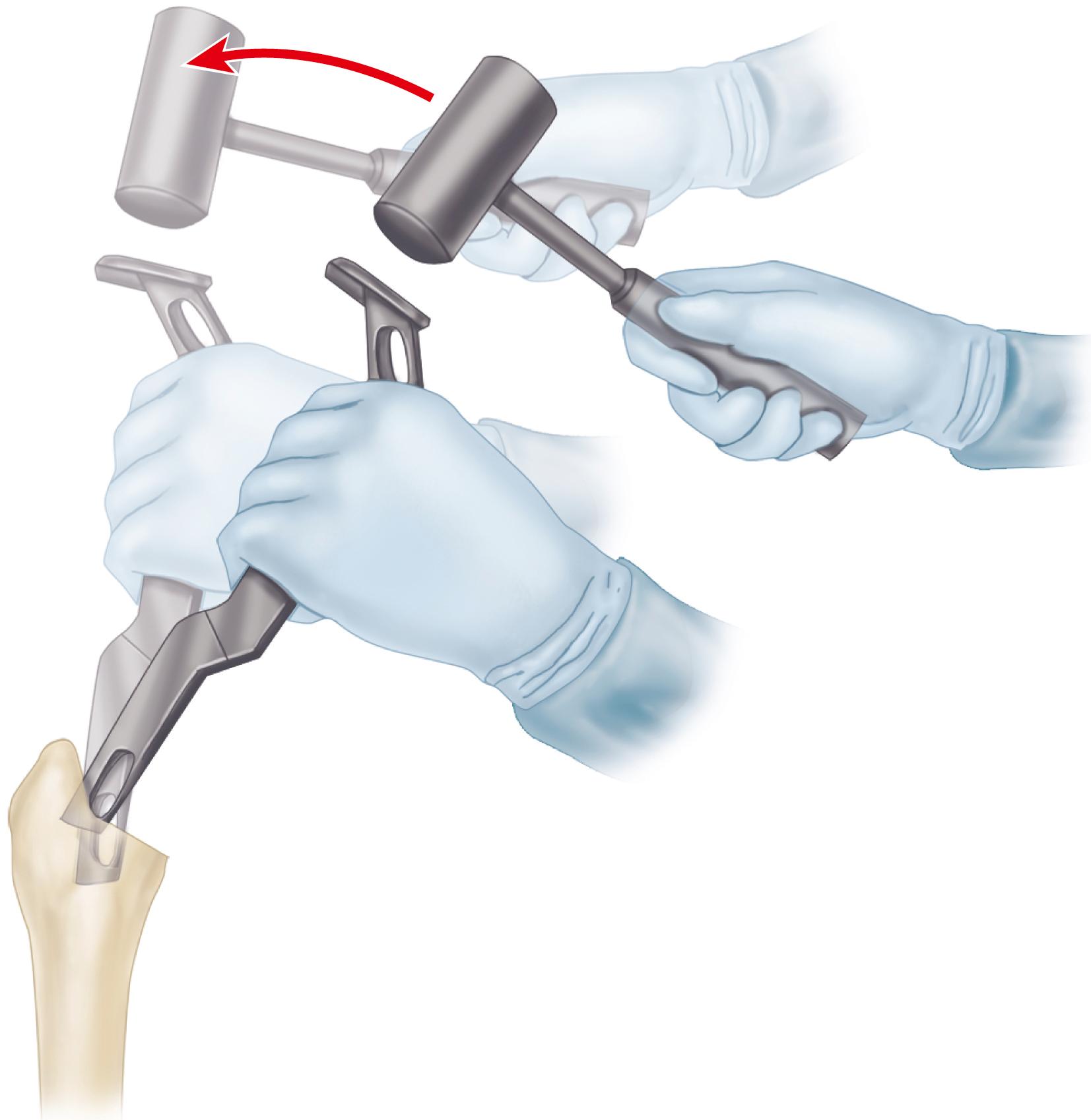 FIGURE 3.51, Removal of remaining lateral edge of femoral neck and medial portion of greater trochanter with box osteotome. SEE TECHNIQUE 3.4.