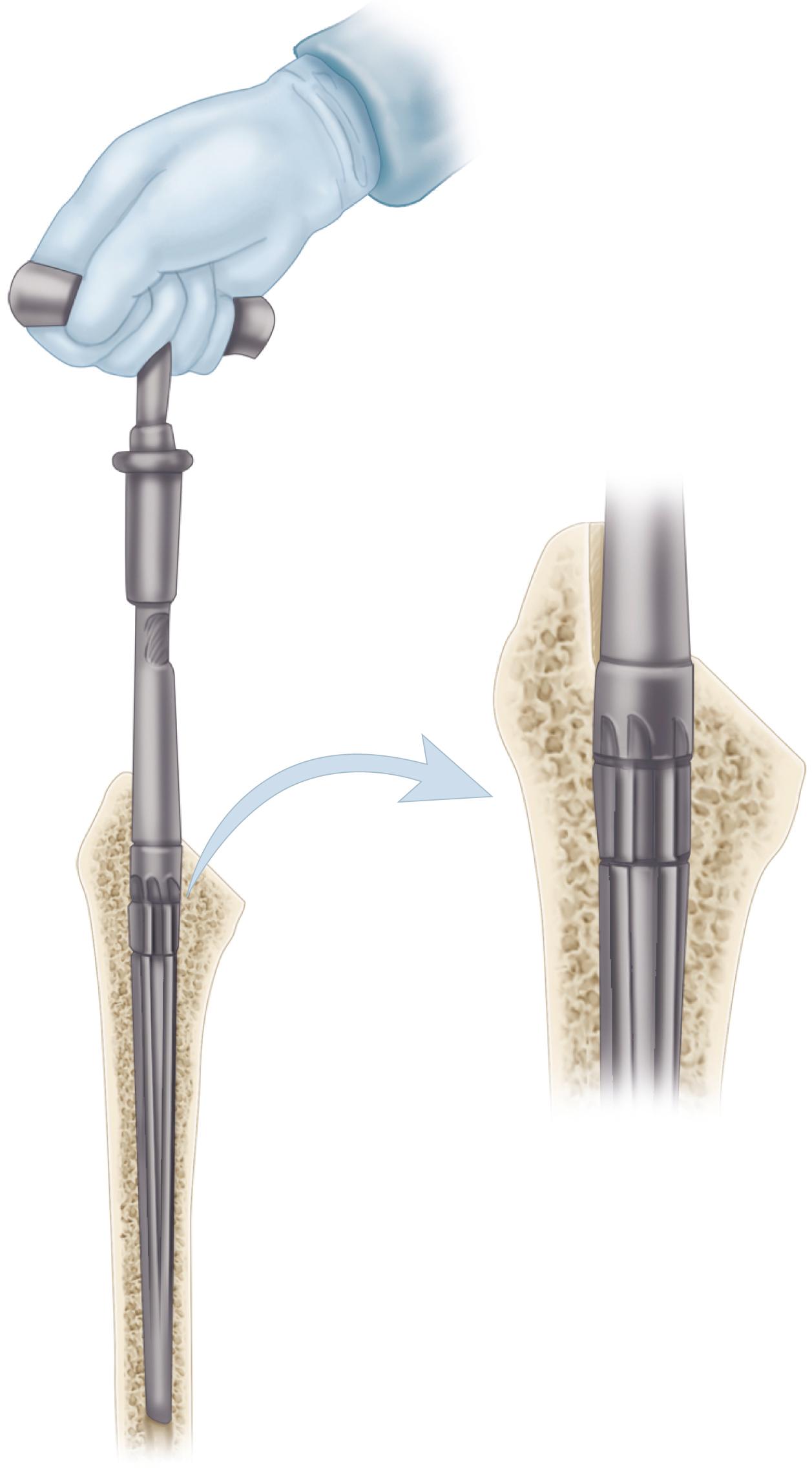FIGURE 3.52, Reaming of femoral canal. Hand or power reamers must be lateralized into greater trochanter to maintain neutral alignment in femoral canal. (Redrawn courtesy Smith & Nephew, Memphis, TN.) SEE TECHNIQUES 3.5 AND 3.6.
