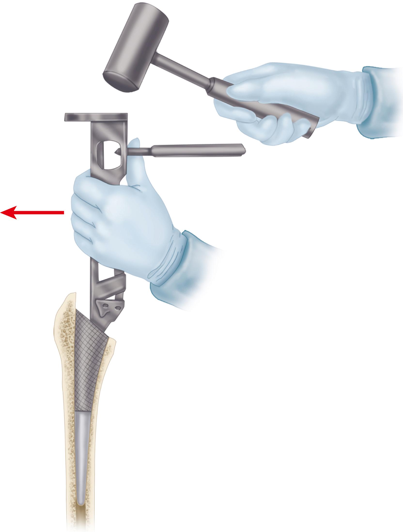 FIGURE 3.53, Femoral broaching. Progressively larger broaches are inserted, lateralizing each one to maintain neutral alignment. (Redrawn courtesy Smith & Nephew, Memphis, TN.) SEE TECHNIQUE 3.5.