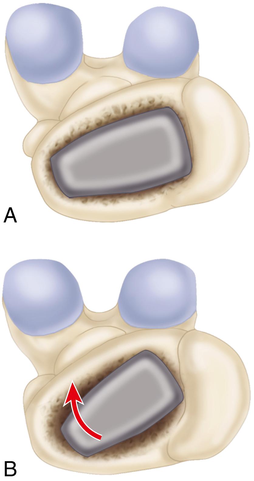 FIGURE 3.54, Femoral component anteversion (as viewed from posterior approach). A, Stem placed in same axis as femoral neck. Largest possible stem size fills metaphysis well and obtains rotational stability. B, Stem placed in excessive anteversion. Largest possible stem size does not completely fill metaphysis and tends to retrovert when femur is loaded. SEE TECHNIQUES 3.5 AND 3.6.