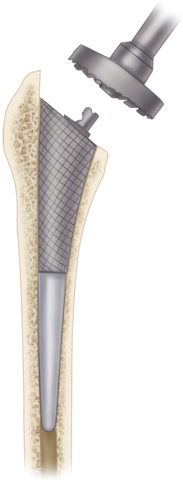 FIGURE 3.55, Planing of calcar with precision reamer placed over broach trunnion. (Redrawn courtesy Smith & Nephew, Memphis, TN.) SEE TECHNIQUES 3.5 AND 3.6.