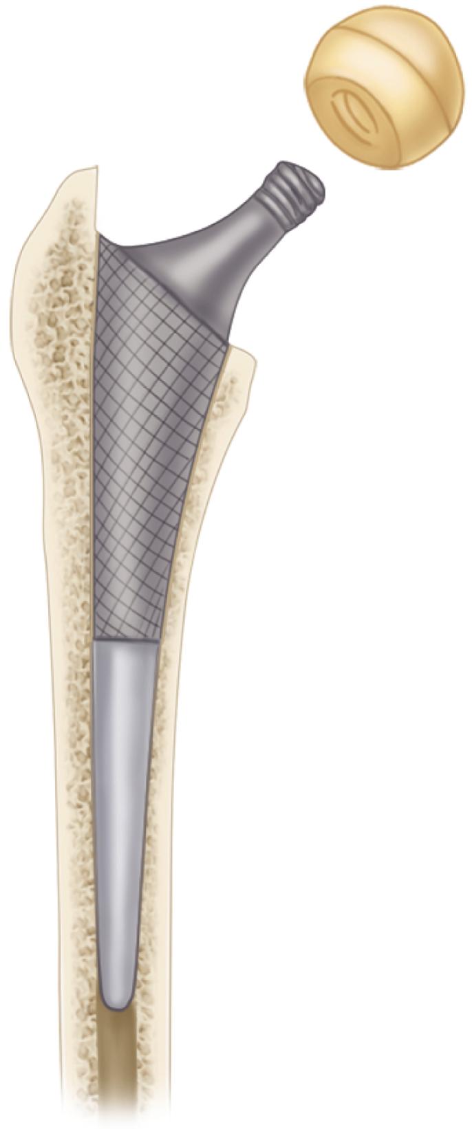 FIGURE 3.56, Assembly of trial head and neck segments determined from preoperative templating. (Redrawn courtesy Smith & Nephew, Memphis, TN.) SEE TECHNIQUE 3.5.