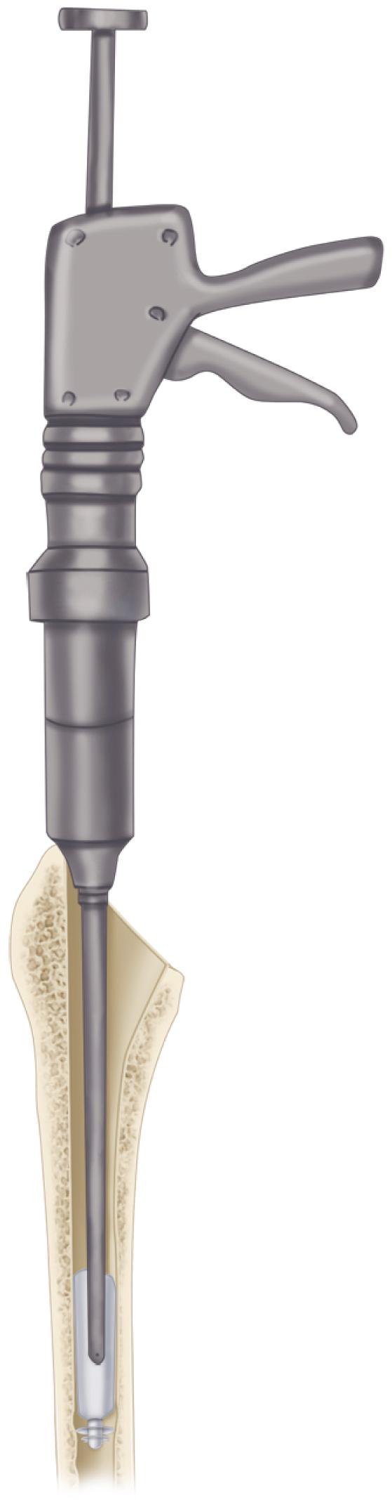 FIGURE 3.58, Retrograde injection of cement with gun. Cement gun with long nozzle can be used to inject semiliquid cement. Distal part of canal is filled first, and tip is slowly withdrawn as cement is injected. Injection is continued until canal is completely filled and tip of nozzle is clear of canal. (Redrawn courtesy Smith & Nephew, Memphis, TN.) SEE TECHNIQUE 3.6.