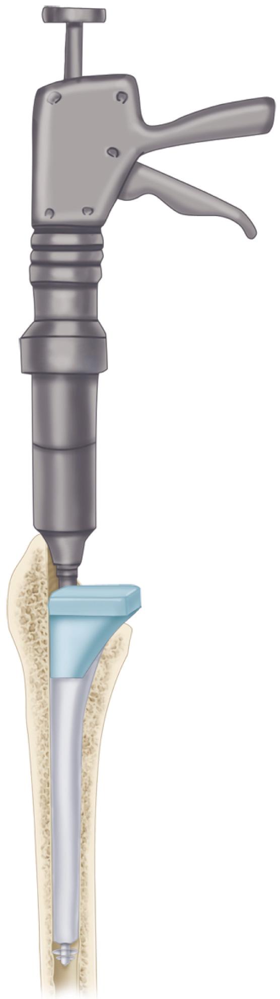 FIGURE 3.59, Cement pressurization. Flexible pressurizing nozzle is placed over end of cement gun to seal proximal femur, and firm pressure is applied as additional cement is injected. (Redrawn Courtesy Smith & Nephew, Memphis, TN.) SEE TECHNIQUE 3.6.