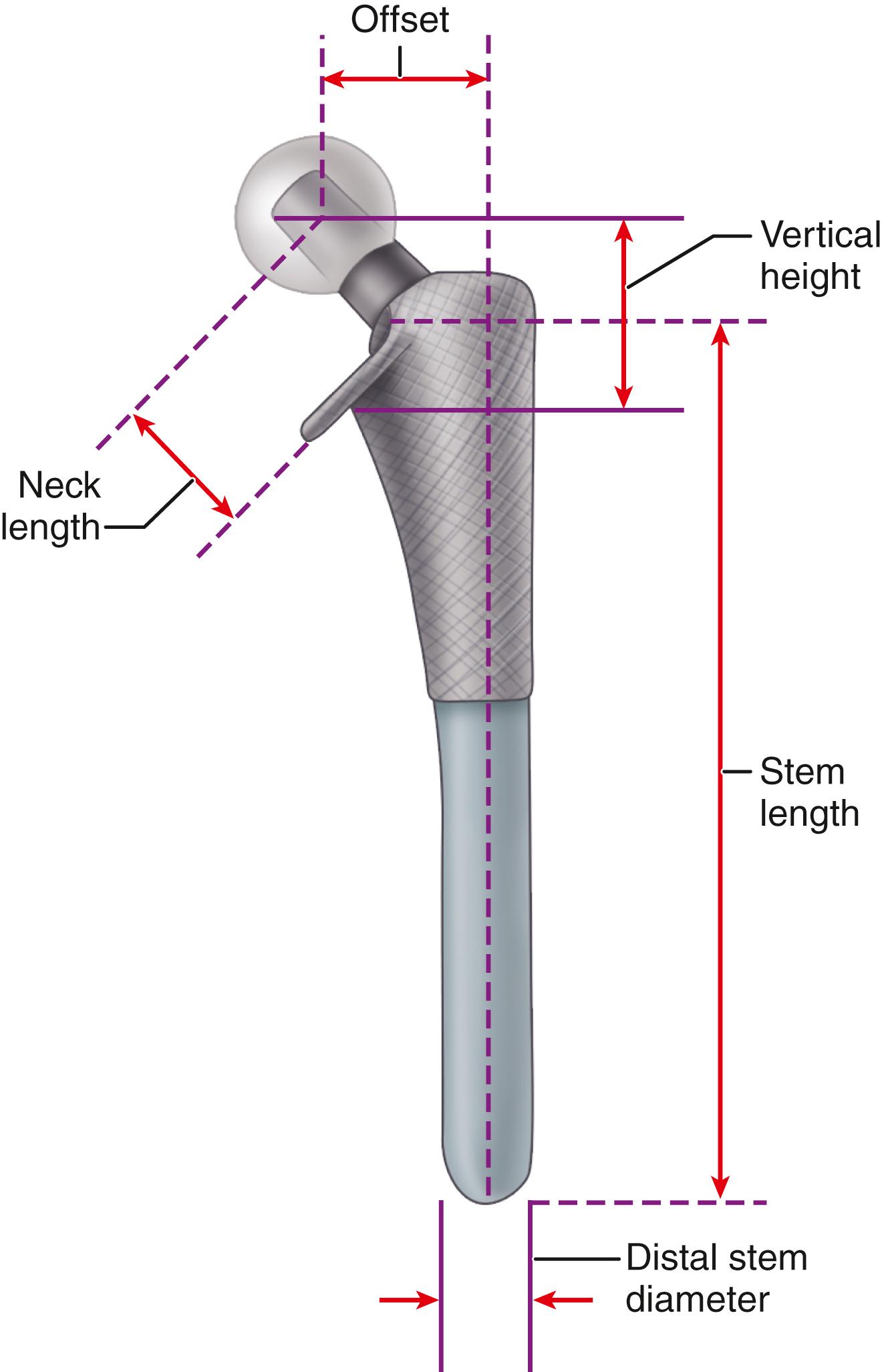 FIGURE 3.6, Features of femoral component. Neck length is measured from center of head to base of collar; head-stem offset, from center of head to line through axis of distal part of stem; stem length, from medial base of collar to tip of stem; and angle of neck, by intersection of line through center of head and neck with another along lateral border of distal half of stem.