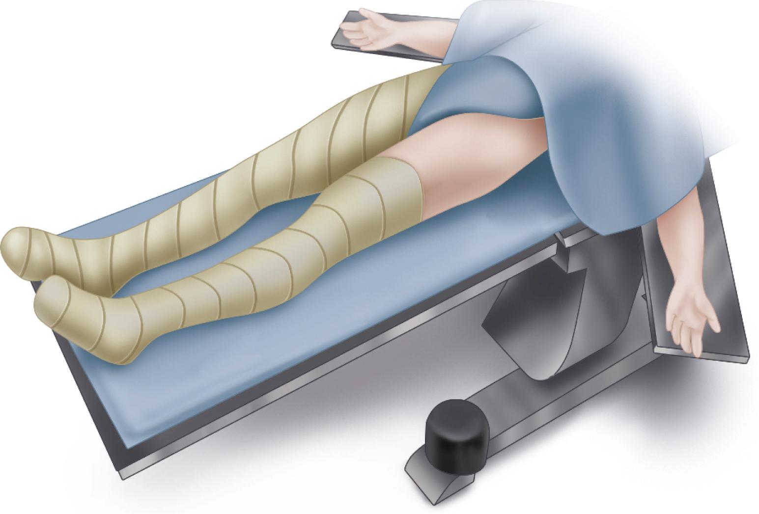 FIGURE 3.61, Direct anterior approach. Patient positioned supine with anterior superior iliac spine placed at level of table break. (Redrawn from Biomet.) SEE TECHNIQUE 3.7.