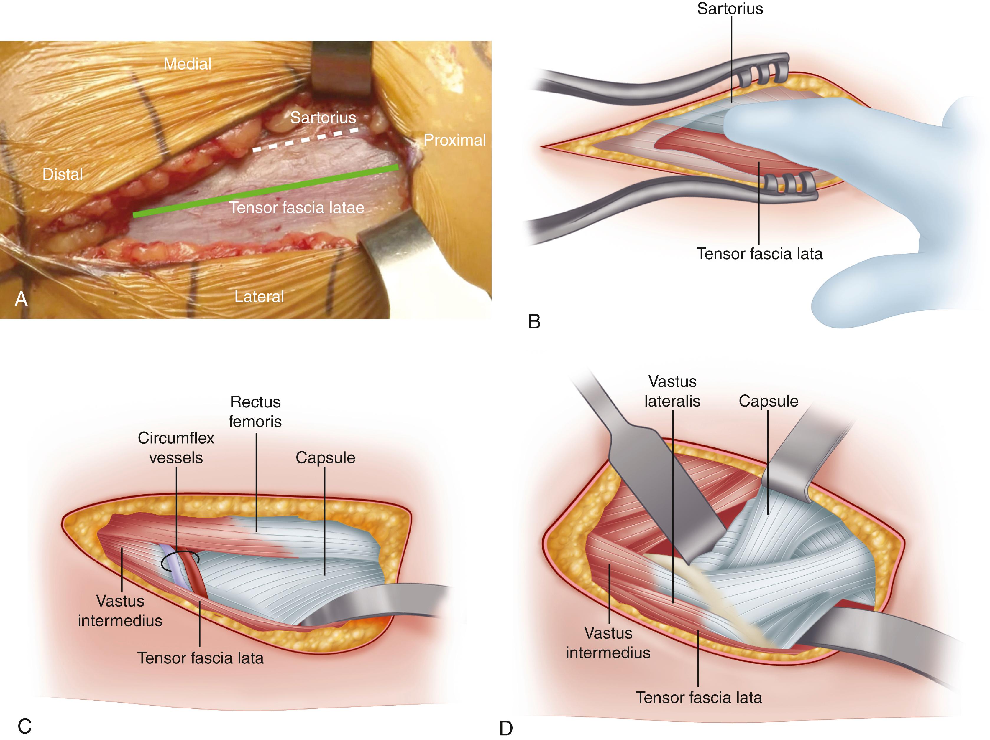 FIGURE 3.62, A , Fascial incision (green line) is positioned over the tensor fascia latae (TFL) muscle and lateral to the interval between TFL and sartorius (dashed white line) . B , Blunt dissection medially beneath fascia leads to interval between TFL and sartorius. C , Within the fat layer at distal extent of interval are branches of the lateral femoral circumflex vessels that must be identified and carefully cauterized. D , Extracapsular placement of retractors superiorly and inferiorly before capsulotomy. An additional retractor may be placed medially beneath rectus femoris. ( A from Post ZD, Orozco F, Diaz-Ledezma C, et al: Direct anterior approach for total hip arthroplasty: indications, technique, and results, J Am Acad Orthop Surg 22:595-603, 2014. B-D redrawn from Depuy.) SEE TECHNIQUE 3.7.