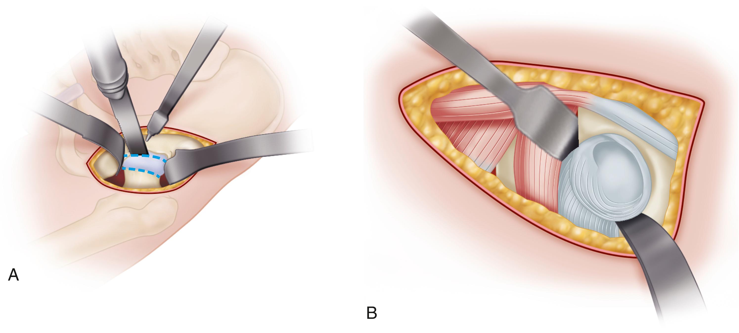 FIGURE 3.63, A , Femoral neck osteotomy. Two parallel cuts made (dashed lines) and “napkin ring” segment removed with a threaded pin. Femoral head is then removed with corkscrew. B , Retractors placed inferior to transverse ligament and also posteriorly to retract femur. ( A redrawn from Biomet. B redrawn from Depuy.) SEE TECHNIQUE 3.7.