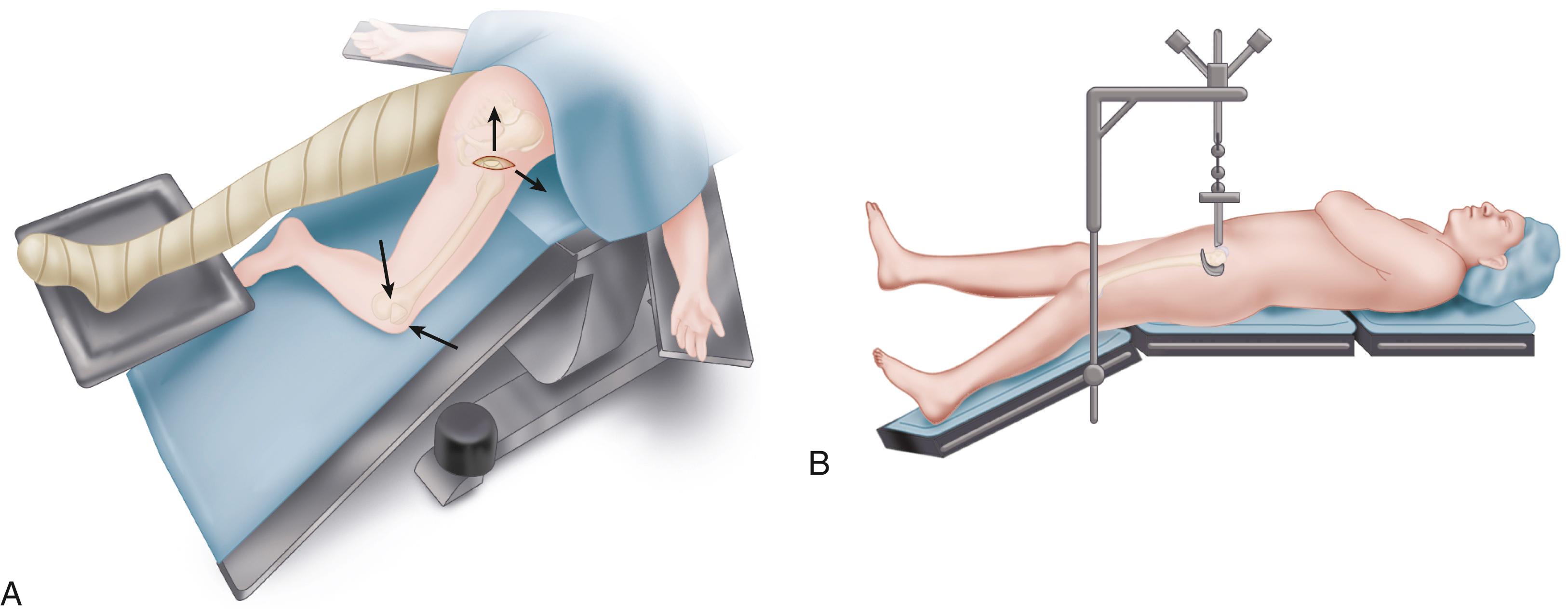 FIGURE 3.64, A , Table position for exposure of femur. Operated limb is placed in figure-of-four position beneath opposite lower limb, and lower end of table is dropped to place hip in hyperextension. Proximal femur must be retracted laterally and upward. B, Accessory hook mounted to table aids femoral elevation. ( A redrawn from Biomet; B courtesy Innomed, Inc. Savannah, GA.) SEE TECHNIQUE 3.7.