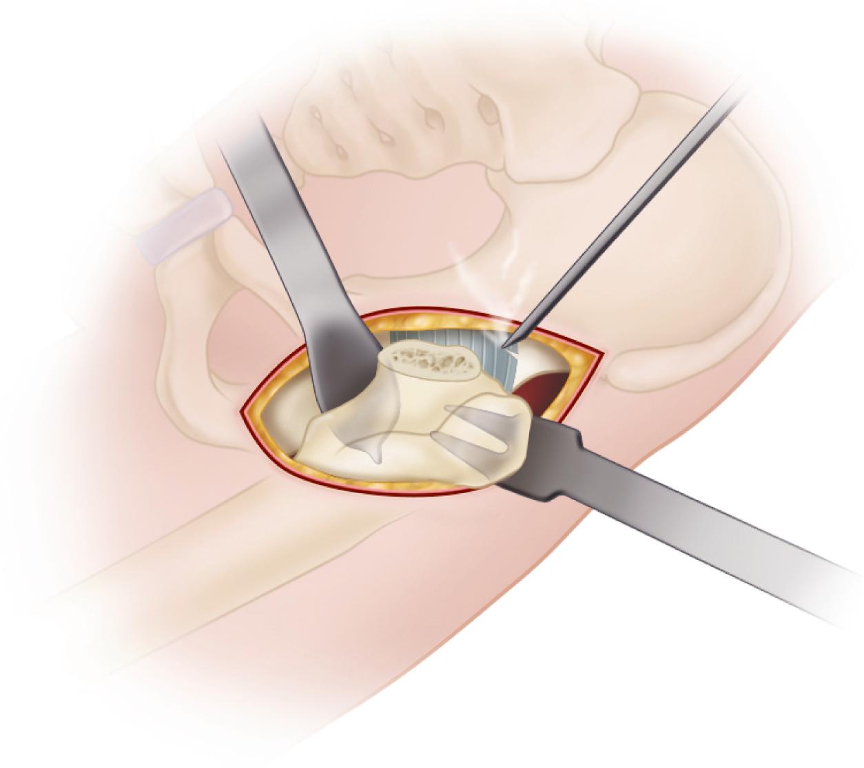 FIGURE 3.65, Soft-tissue release for femoral elevation. Superior capsule is released from anterior to posterior to completely expose trochanteric fossa and allow elevation of femur without undue force. (Redrawn from Biomet.) SEE TECHNIQUE 3.7.