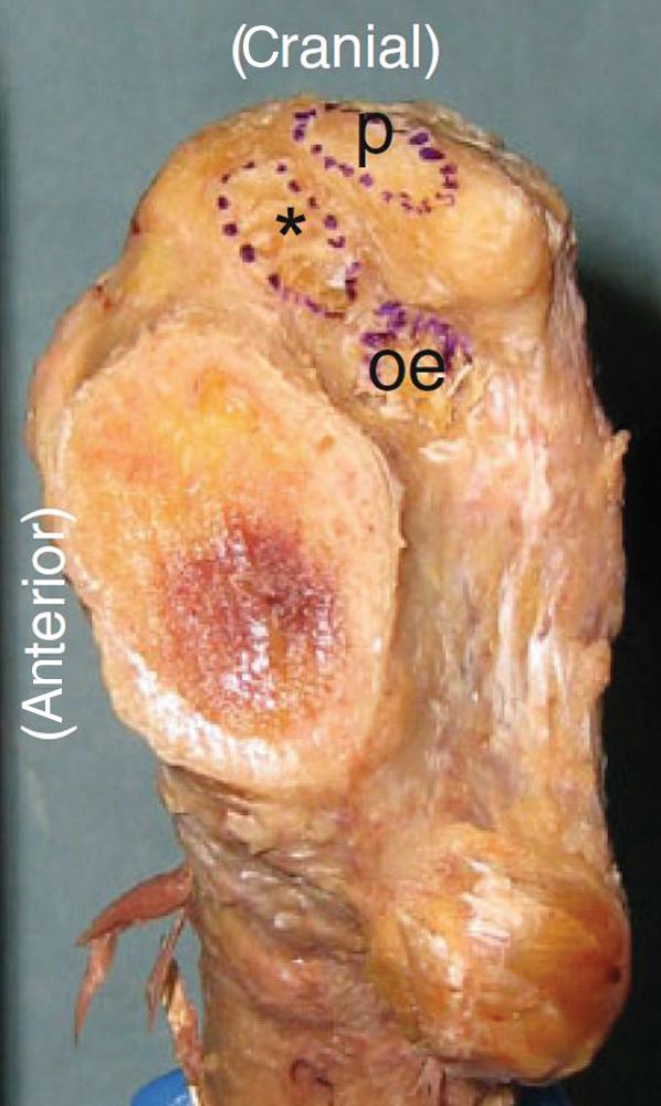 FIGURE 3.66, Insertions of short external rotators as viewed from medial. Piriformis ( p ) inserts near cephalad extent of greater trochanter. Conjoined tendon ( asterisk ) and obturator externus ( oe ) insert more distal. (From Ito Y, Matsushita I, Watanabe H, Kimura T: Anatomic mapping of short external rotators shows the limit of their preservation during total hip arthroplasty, Clin Orthop Relat Res 470:1690, 2012.) SEE TECHNIQUE 3.7.