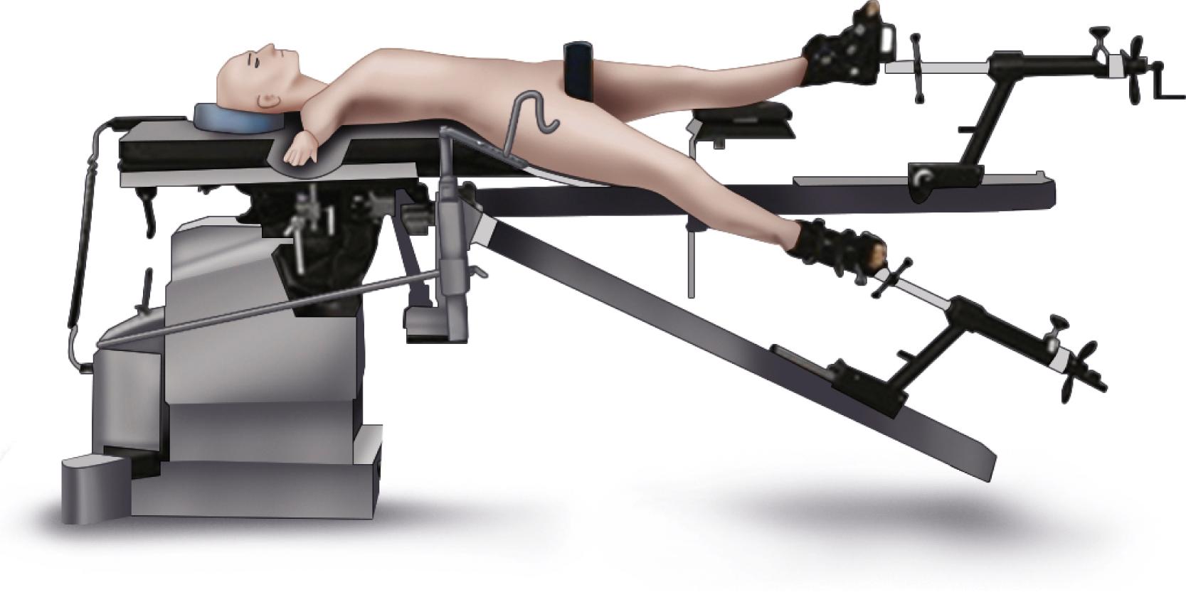 FIGURE 3.68, Dedicated table for positioning during direct anterior approach. Surgeon controls elevation of femur with integral hook.