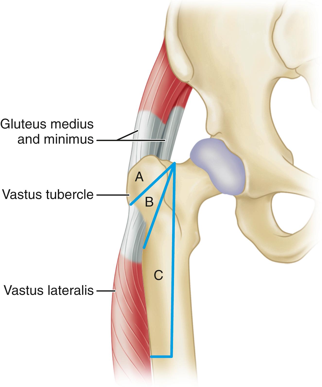 FIGURE 3.70, Types of trochanteric osteotomy and their relationships to muscular attachments. A, Standard trochanteric osteotomy with only superior abductor attachment. B, Trochanteric slide with abductors and vastus lateralis attached to trochanteric fragment; C, Extended trochanteric osteotomy.